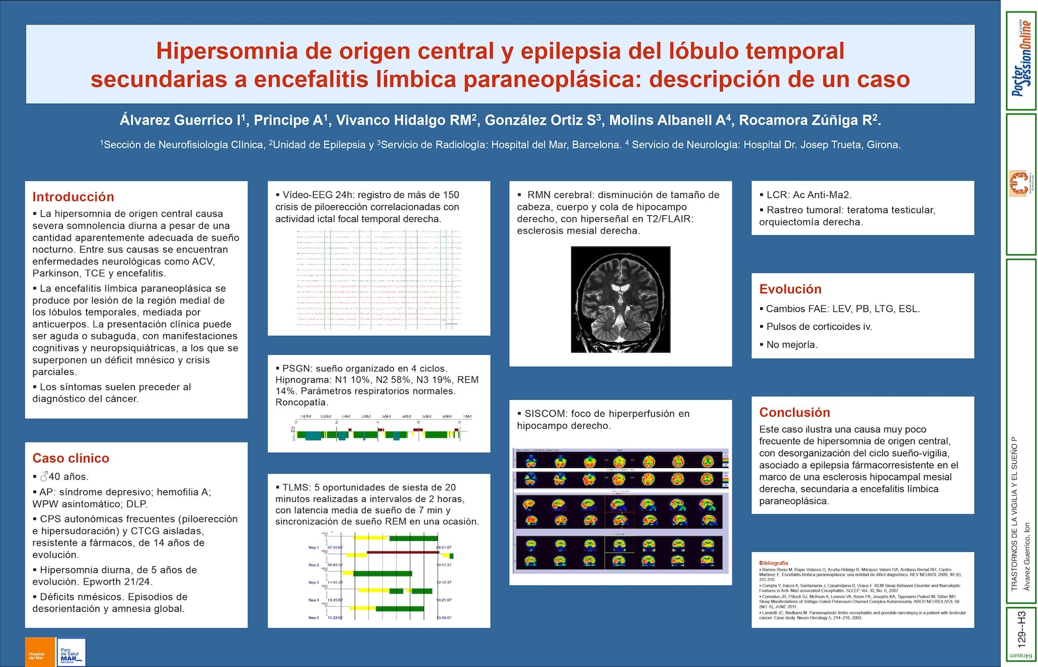 Hipersomnia de origen central y epilepsia del lóbulo temporal secundarias a encefalitis límbica paraneoplásica: descripción de un caso