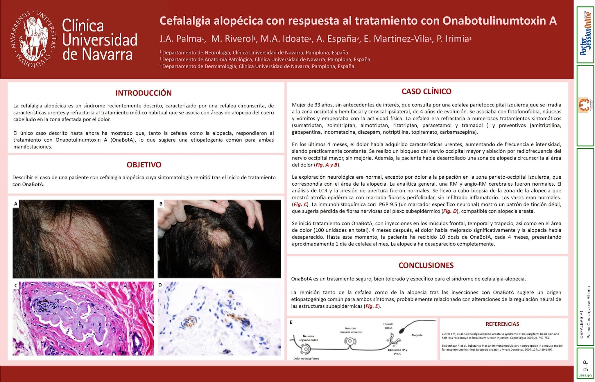 Cefalalgia alopécica con respuesta al tratamiento con onabotulinumtoxinA
