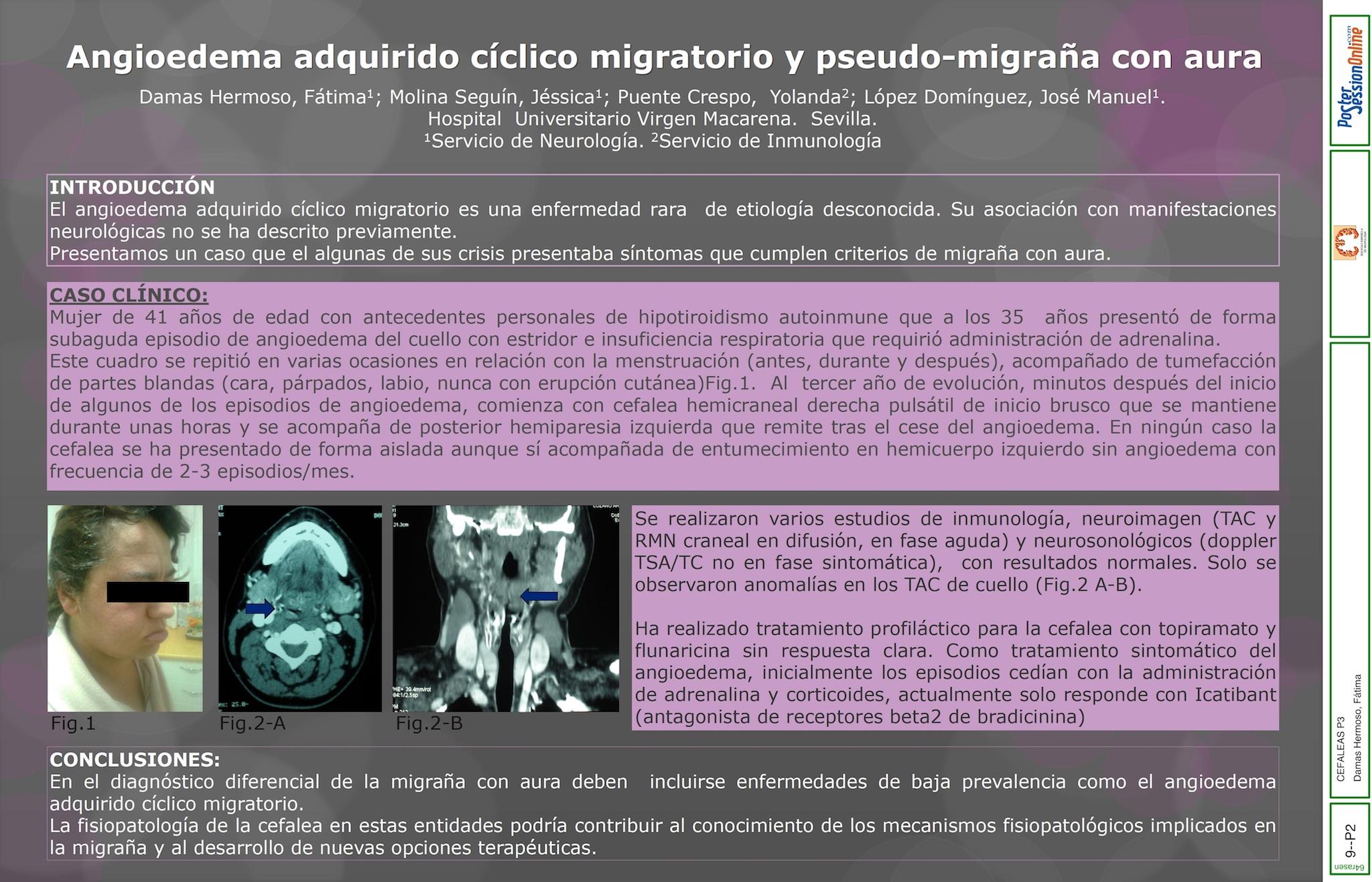 Angioedema adquirido cíclico migratorio con afectación neurológica