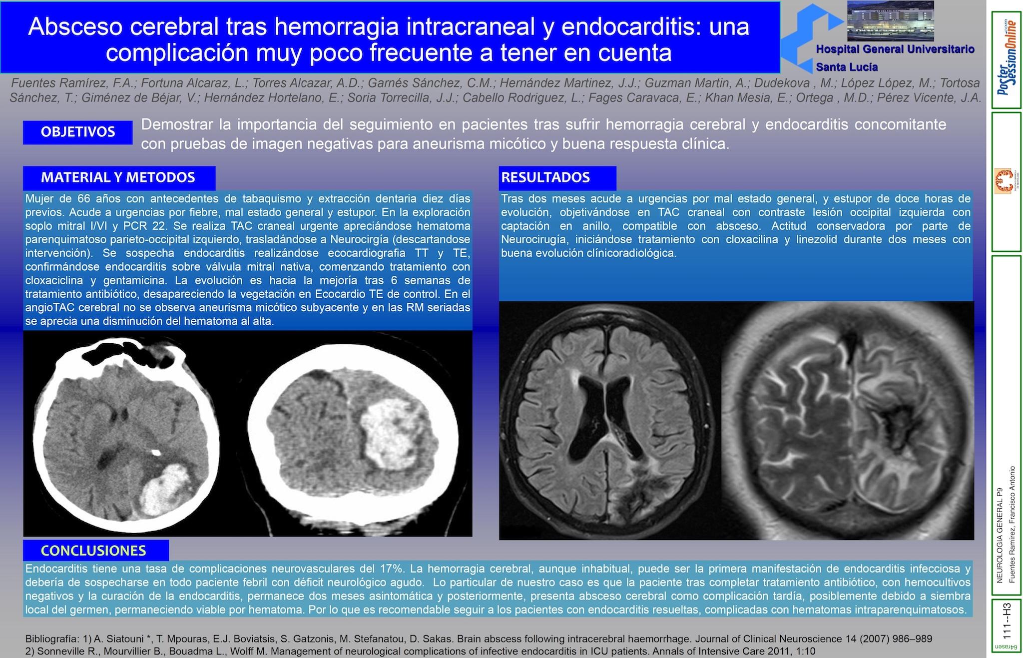 Absceso cerebral tras hemorragia intracraneal y endocarditis: una complicación muy poco frecuente a tener en cuenta.