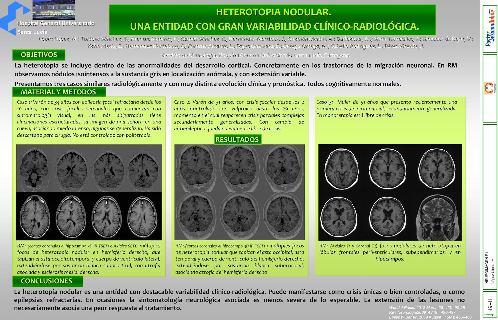 HETEROTOPIA NODULAR. UNA ENTIDAD CON GRAN VARIABILIDAD CLÍNICO-RADIOLÓGICA.