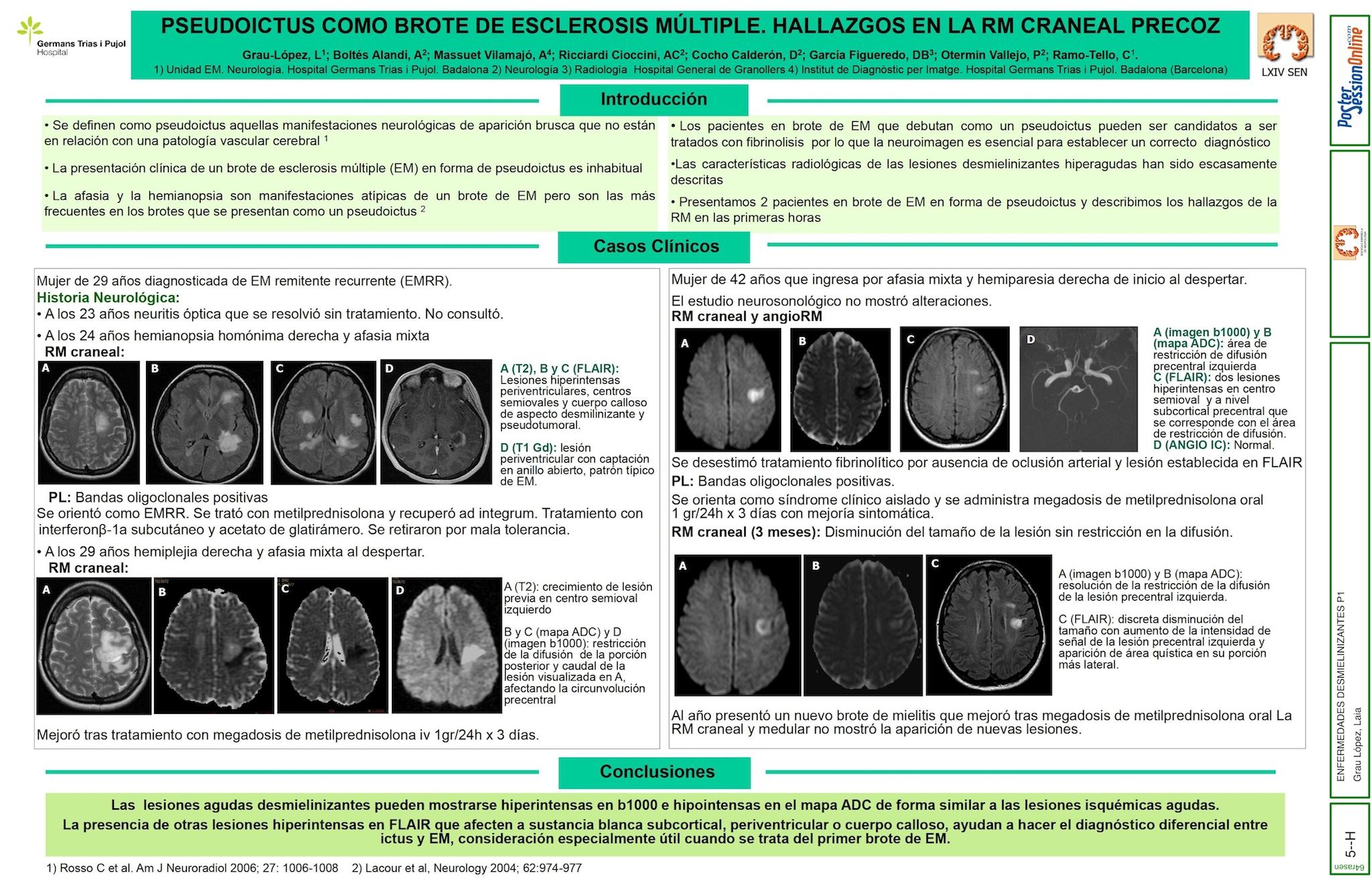 “Pseudo-Ictus” como brote de esclerosis múltiple. Hallazgos en la RM craneal precoz