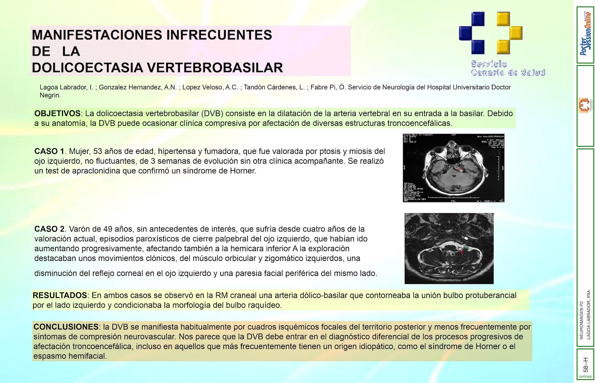 MANIFESTACIONES INFRECUENTES DE LA DOLICOECTASIA VERTEBROBASILAR