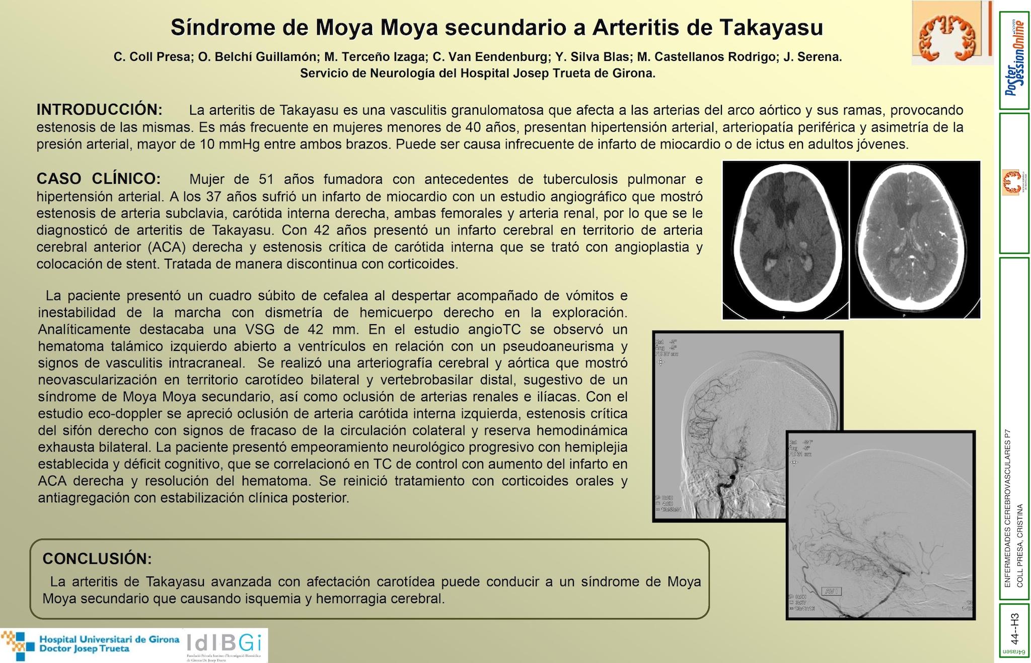 Síndrome de moya moya secundario a arteritis de Takayasu