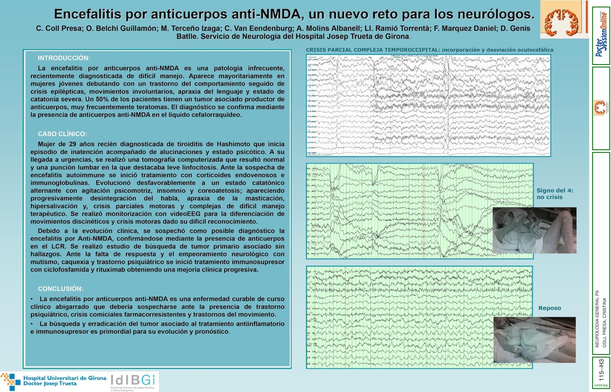 Encefalitis por anticuerpos anti-NMDA, un nuevo reto para los neurólogos
