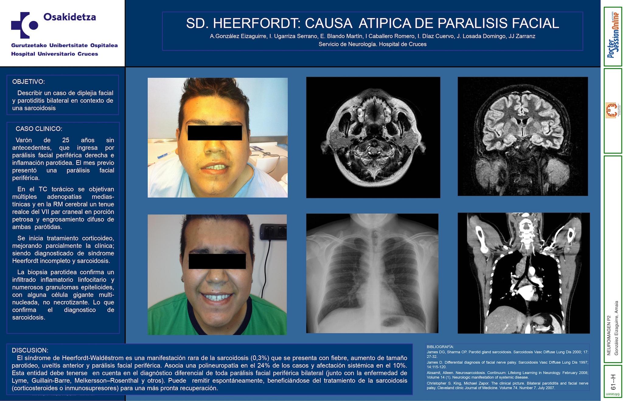 Sd. Heerfordt: Causa atipica de paralisis facial.