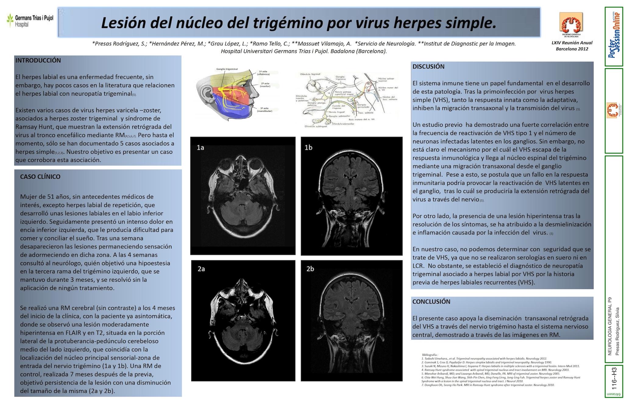 Lesión del núcleo del trigémino por virus herpes zoster.