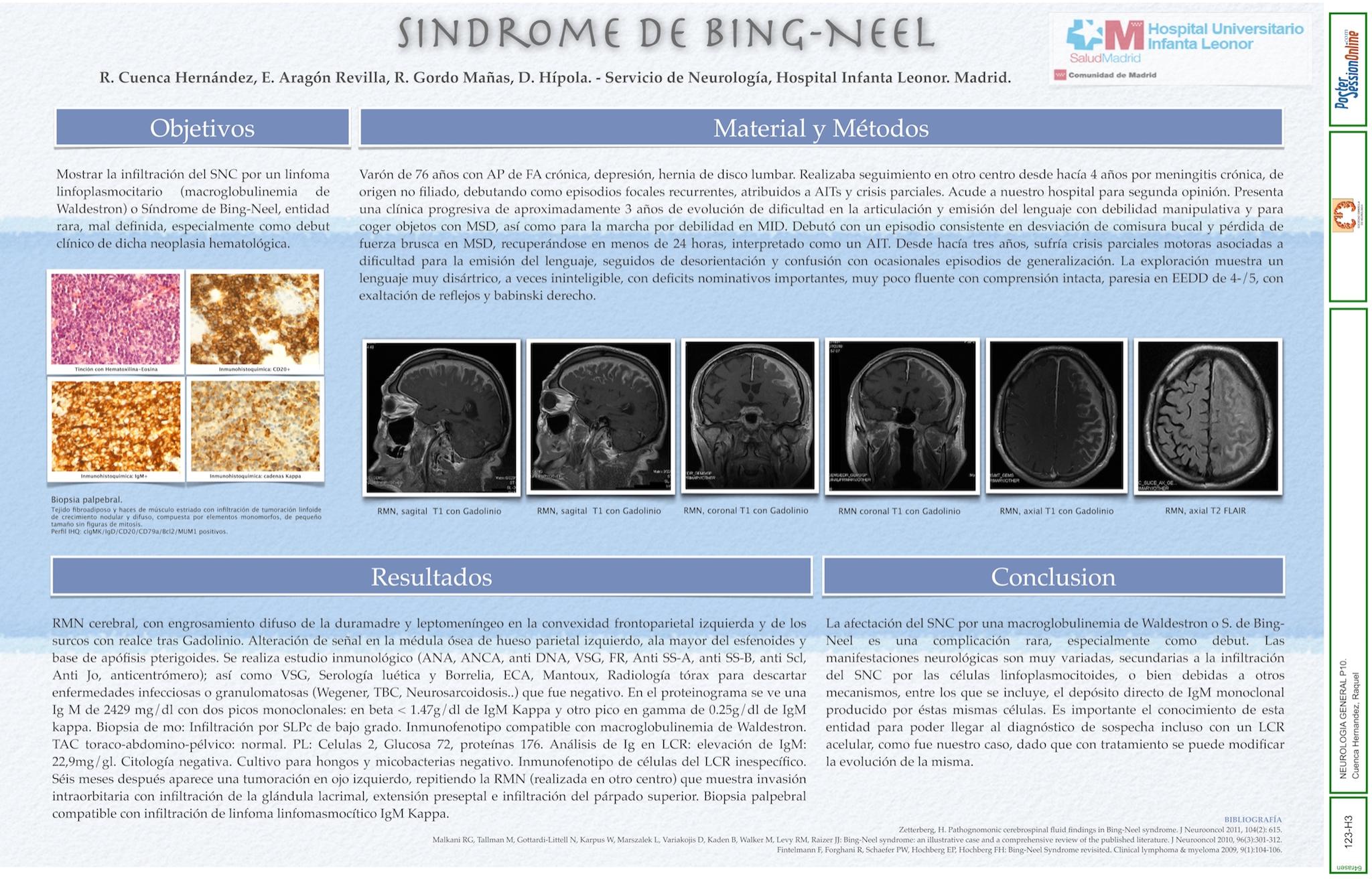 Sindrome de Bing Neel