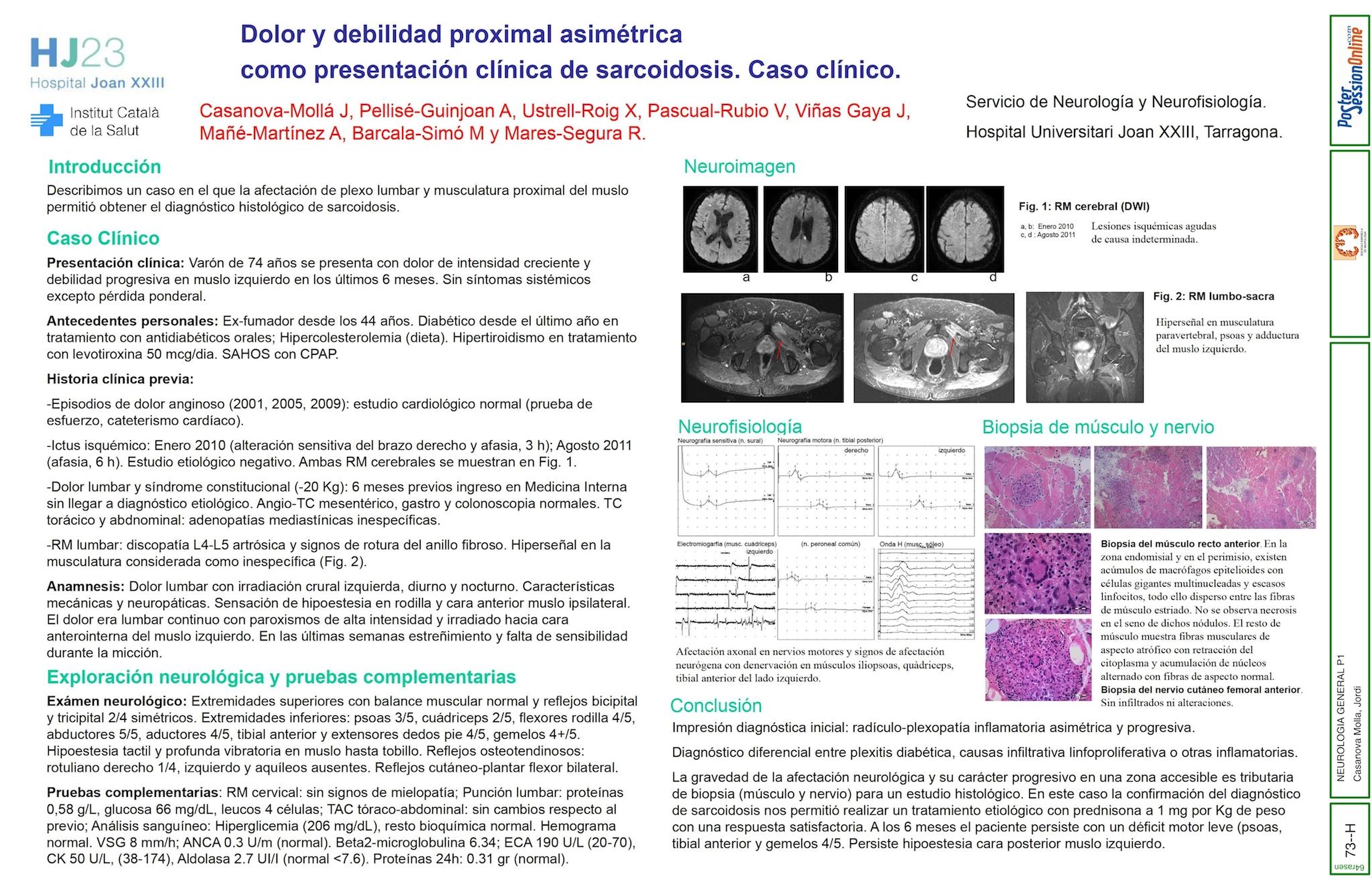 Dolor y debilidad proximal asimétrica como presentación clínica de sarcoidosis. Caso clínico.