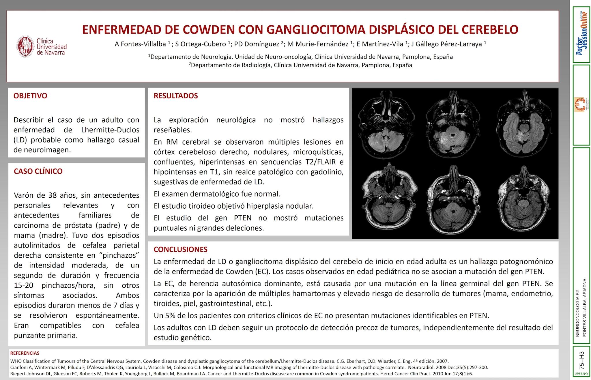 Enfermedad de Cowden con gangliocitoma displásico del cerebelo.