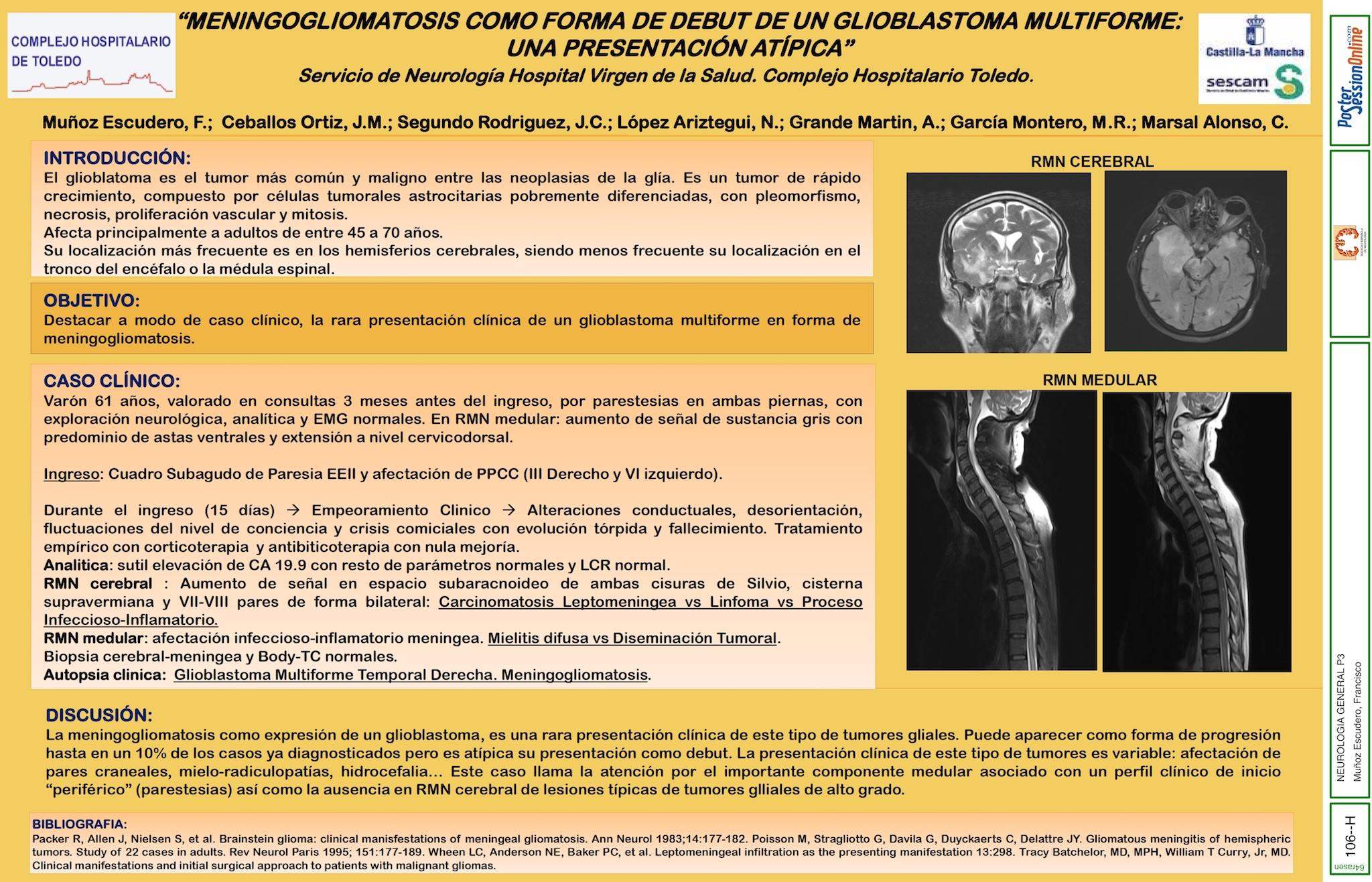 MENINGOGLIOMATOSIS COMO FORMA DE DEBUT DE GLIOBLASTOMA MULTIFORME:UNA ATIPICA PRESENTACION