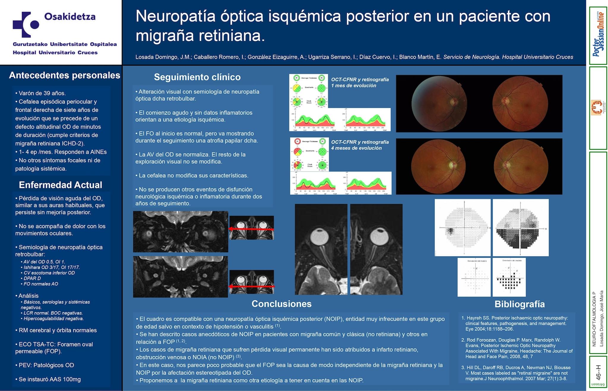 Neuropatía óptica isquémica posterior en un paciente con migraña retiniana.