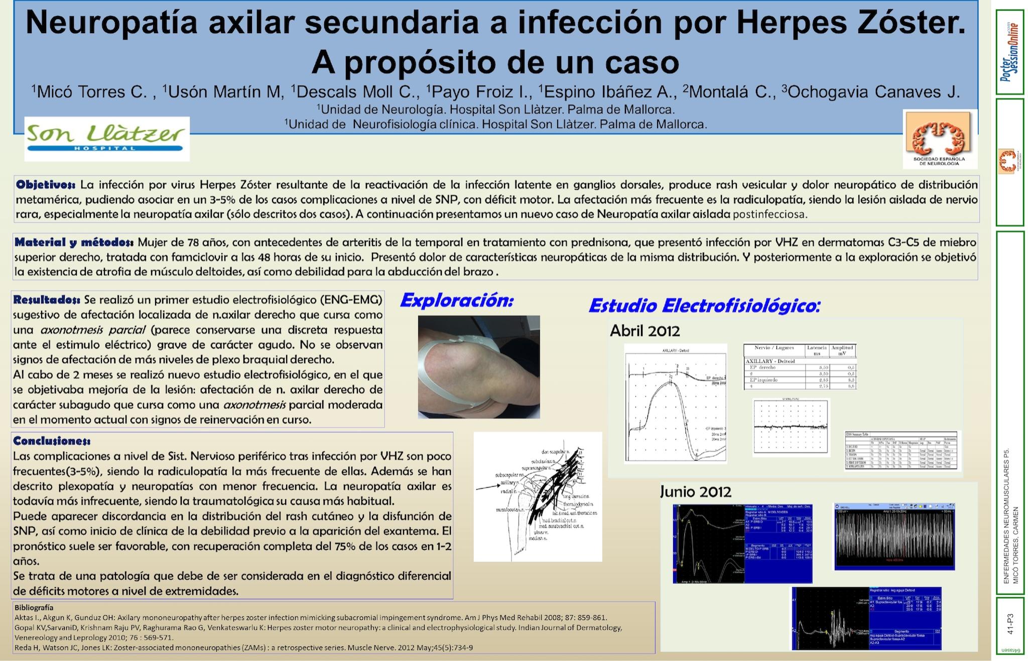 NEUROPATÍA AXILAR SECUNDARIA A INFECCIÓN POR HERPES ZOSTER. A PROPÓSITO DE UN CASO.
