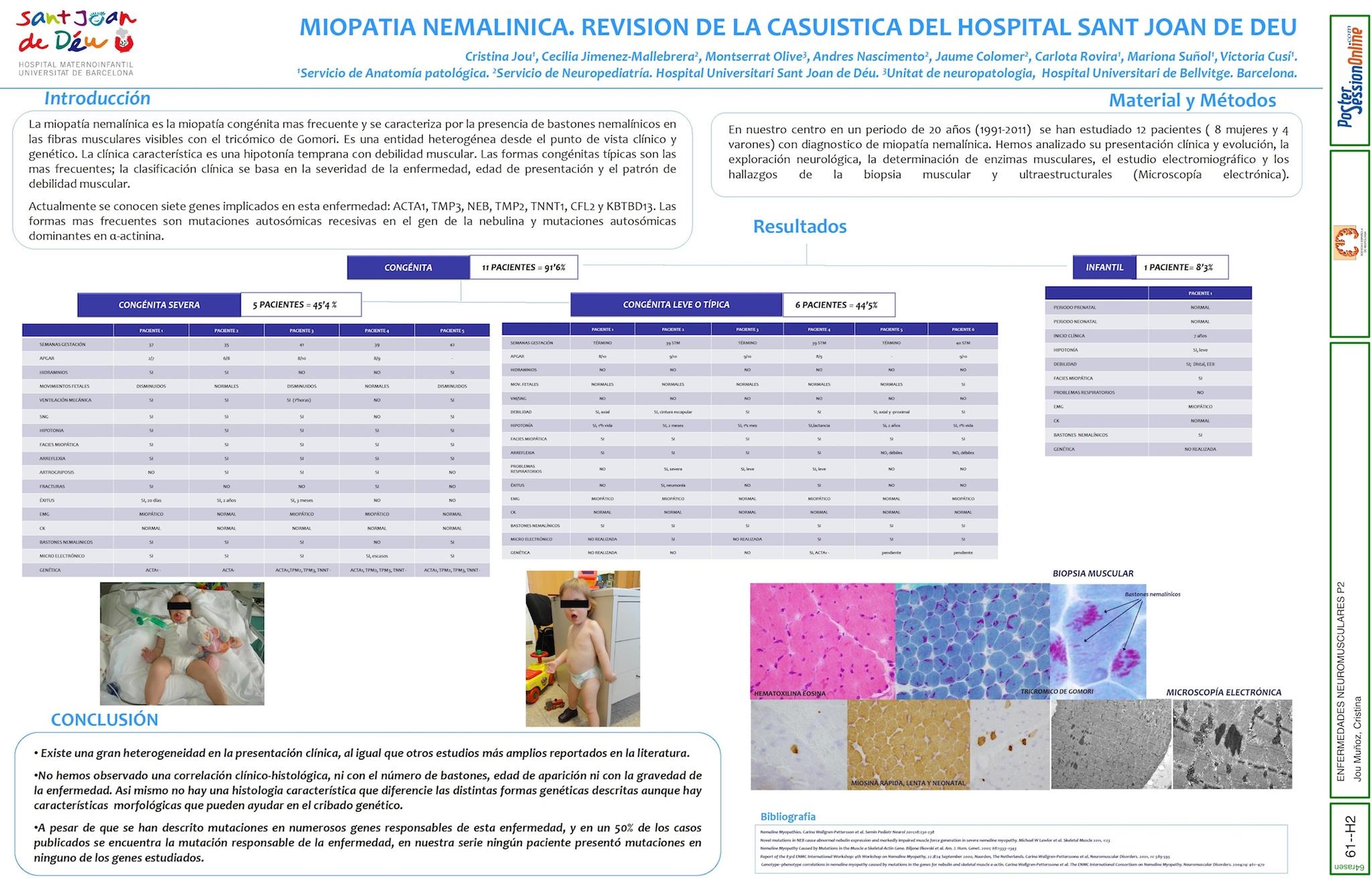 MIOPATIA NEMALINICA. REVISION DE LA CASUISTICA DEL HOSPITAL SANT JOAN DE DEU.