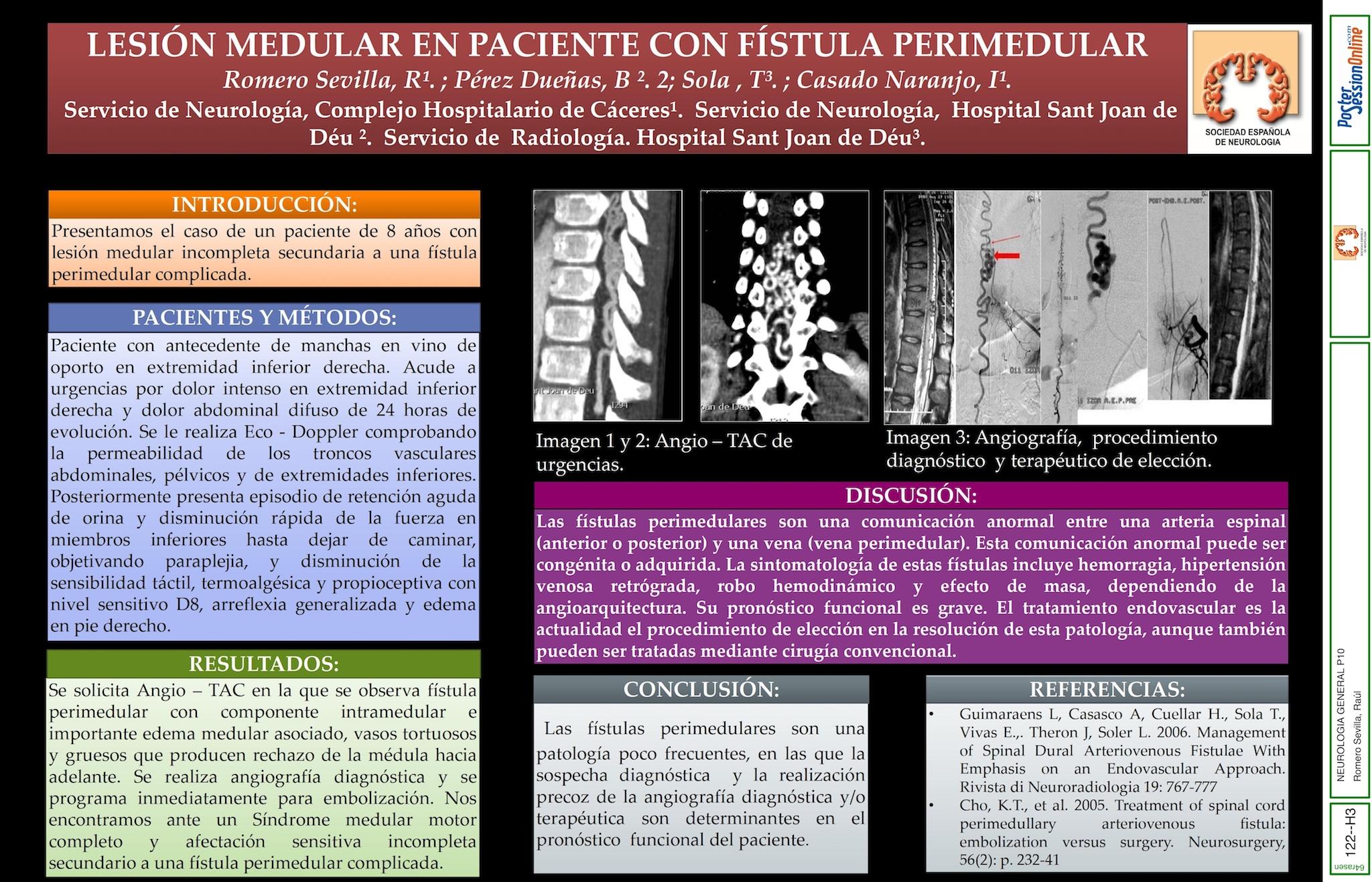 Lesión  medular en paciente con fístula perimedular.