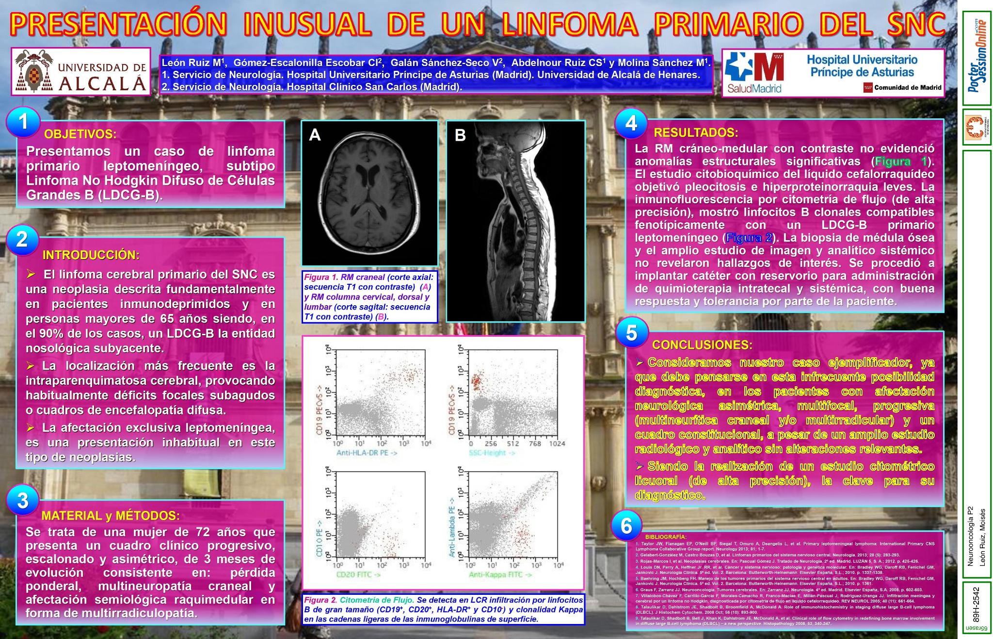 Presentación inusual de un linfoma primario del SNC