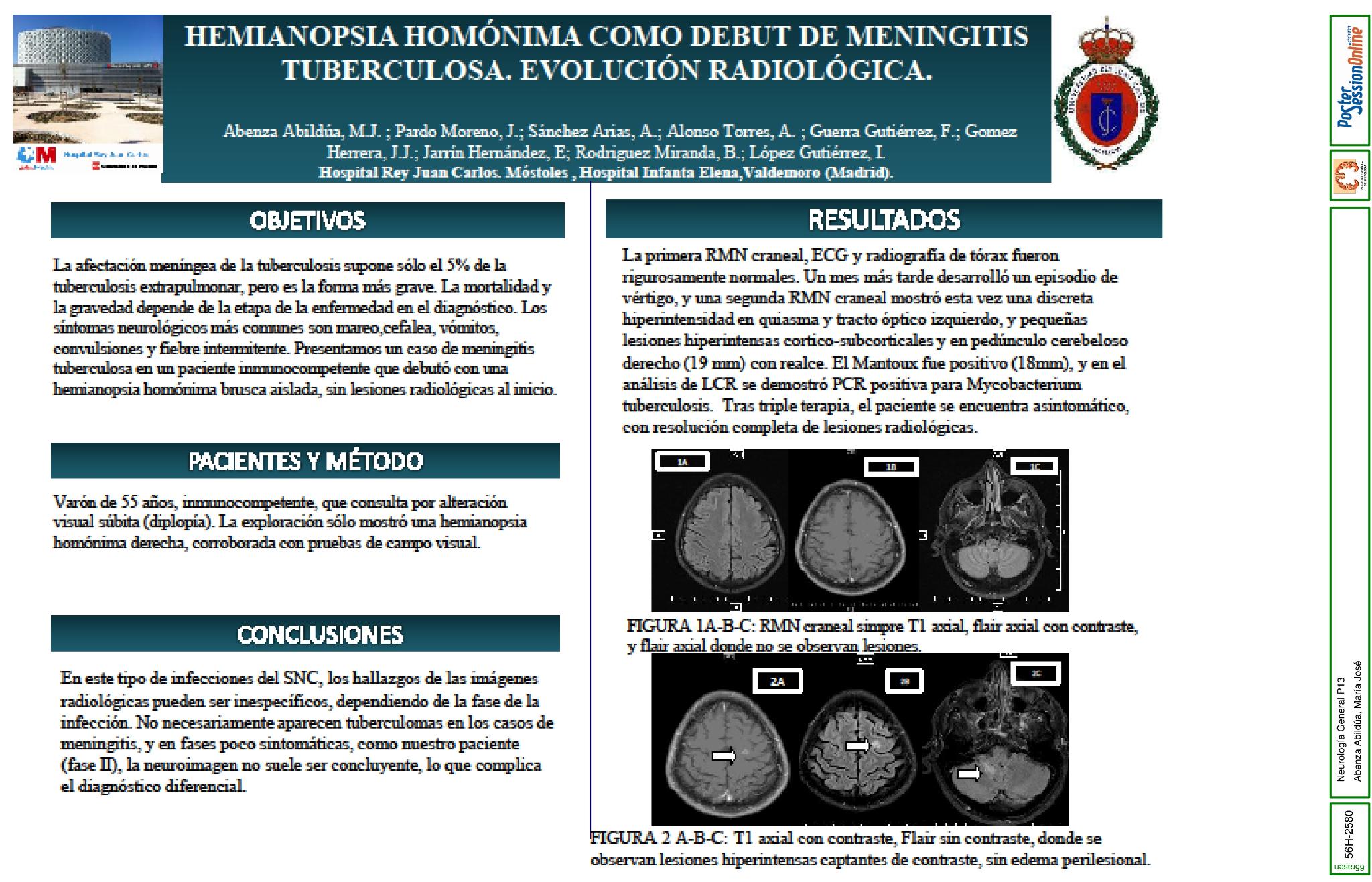 Hemianopsia homónima como debut de meningitis tuberculosa. Evolución radiológica