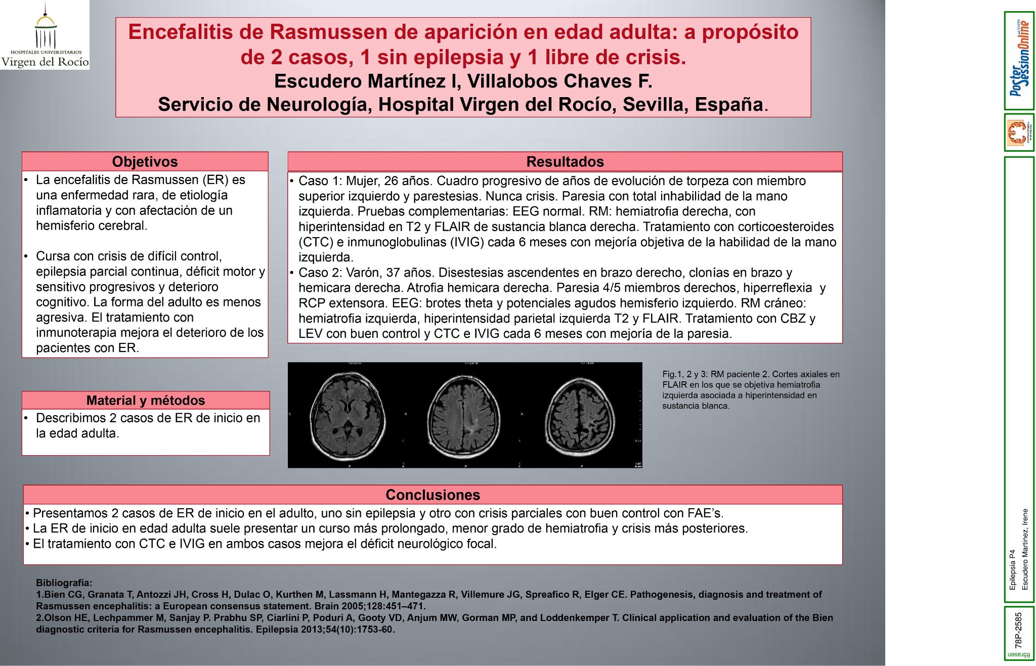 Encefalitis de Rasmussen de aparición en edad adulta: a propósito de 2 casos, 1 sin epilpesia y 1 libre de crisis