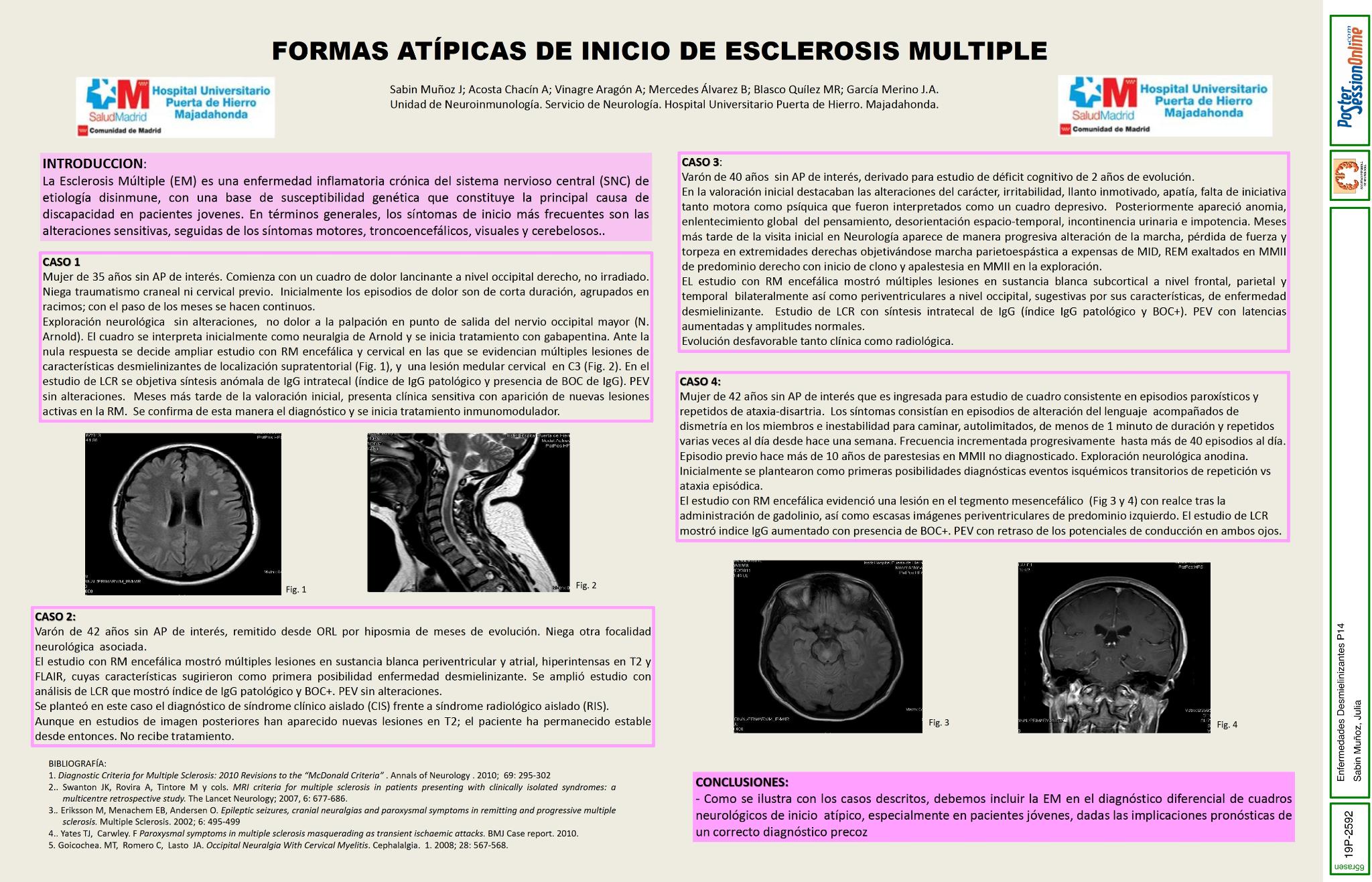 Formas Atípicas de inicio de Esclerosis Múltple.