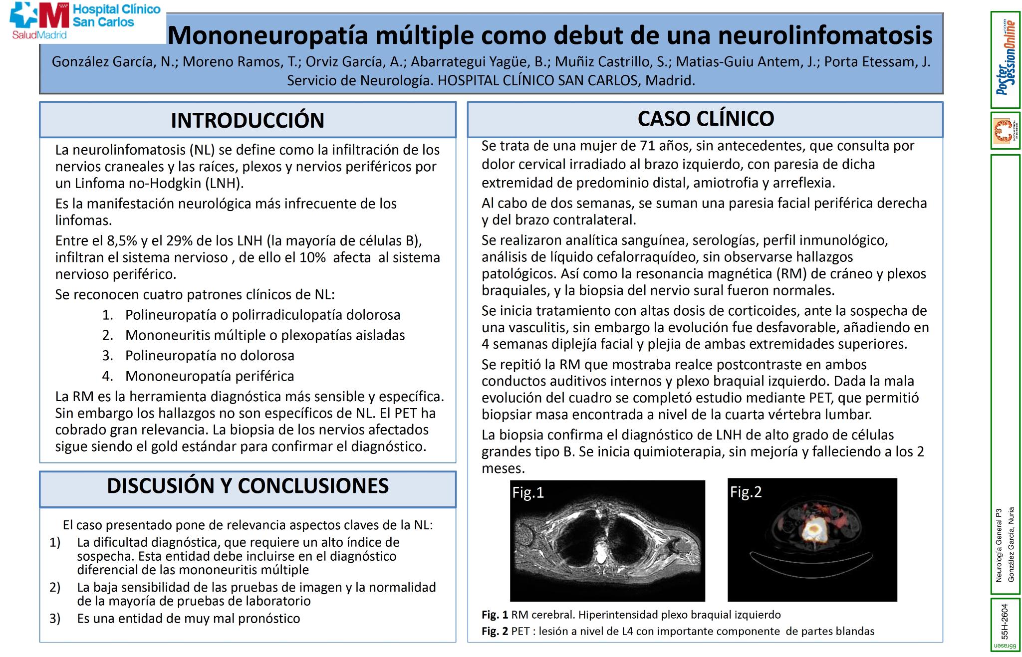 Mononeuropatía múltiple como debut de una neurolinfomatosis