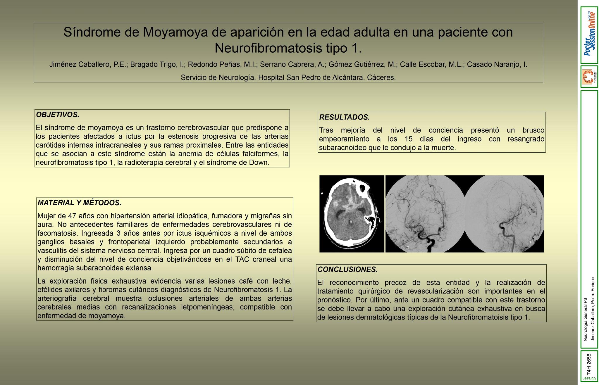Síndrome de moyamoya de aparición en la edad adulta en una paciente con neurofibromatosis tipo 1