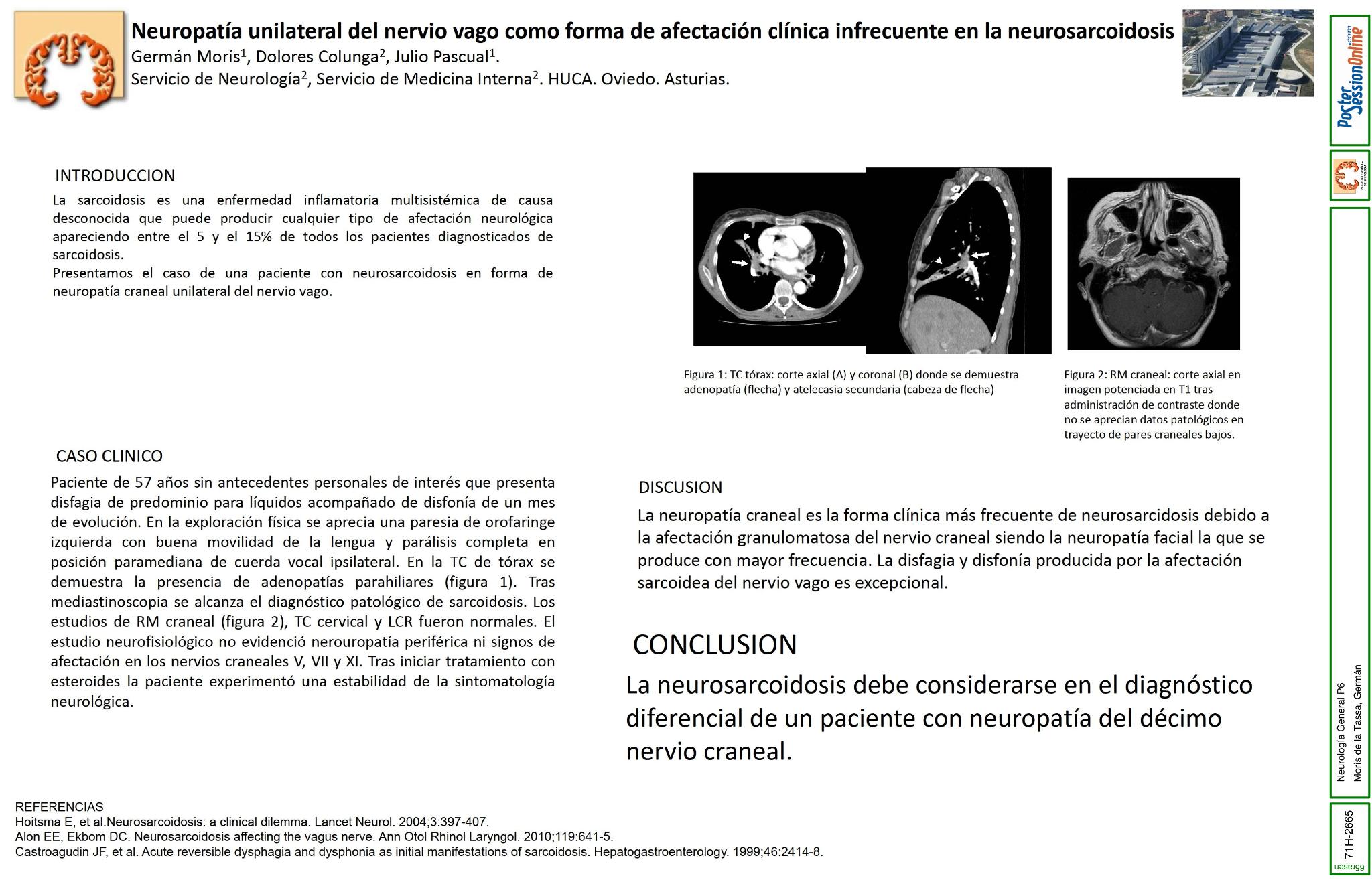 Neuropatía unilateral del nervio vago como forma de afectación clínica infrecuente en la neurosarcoidosis