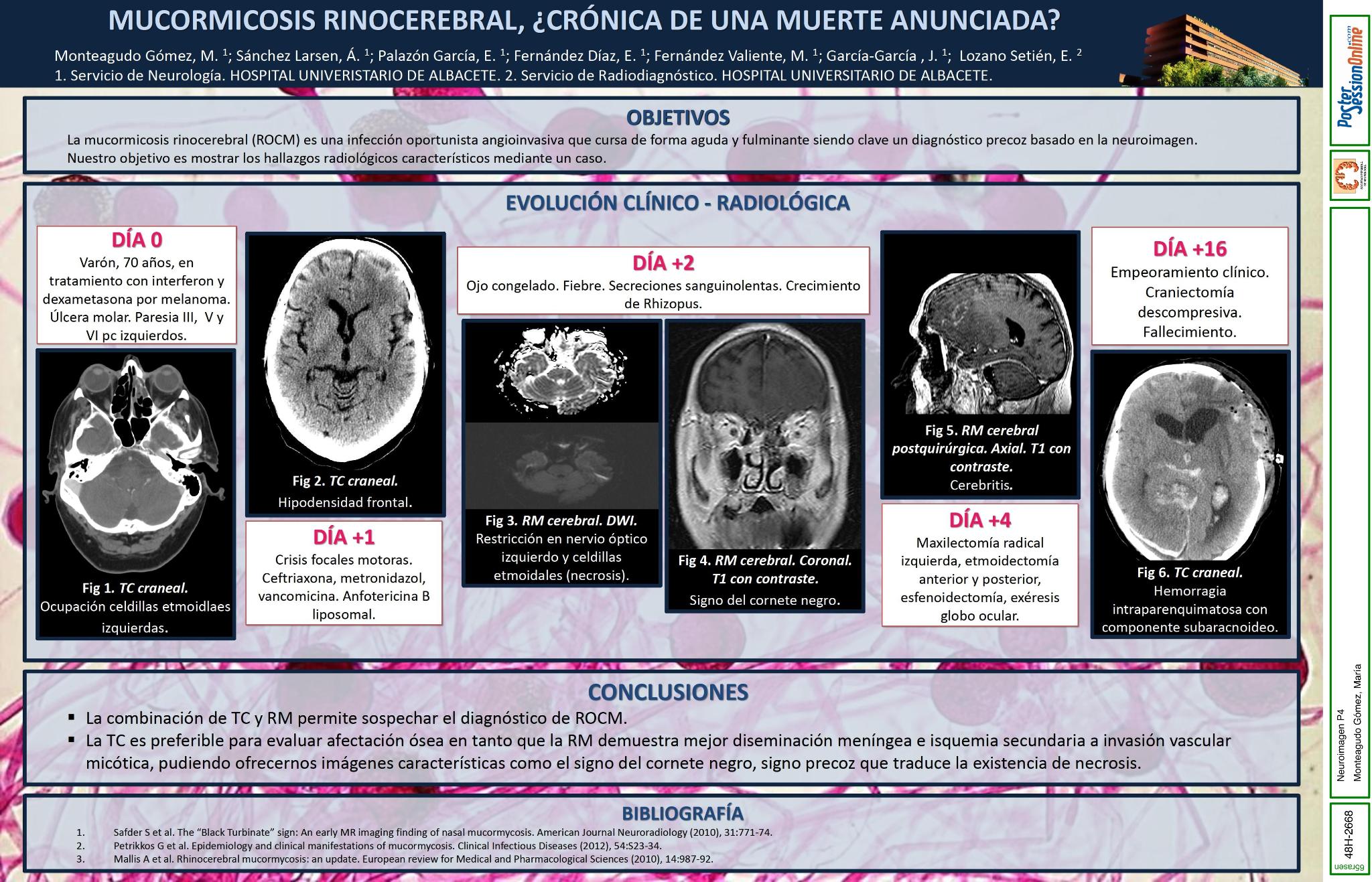 Mucormicosis rinocerebral, ¿crónica de una muerte anunciada?