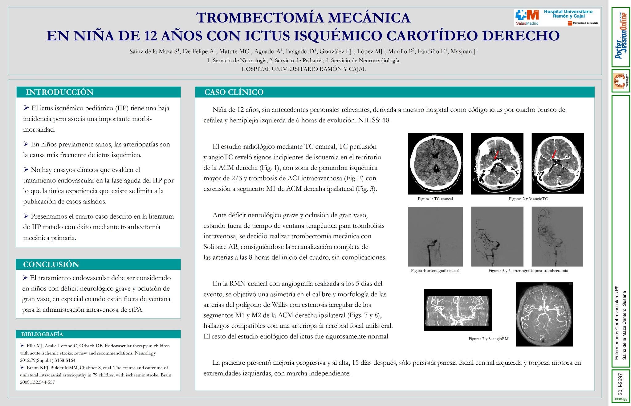Trombectomía mecánica en niña de 12 años con ictus isquémico carotídeo derecho.