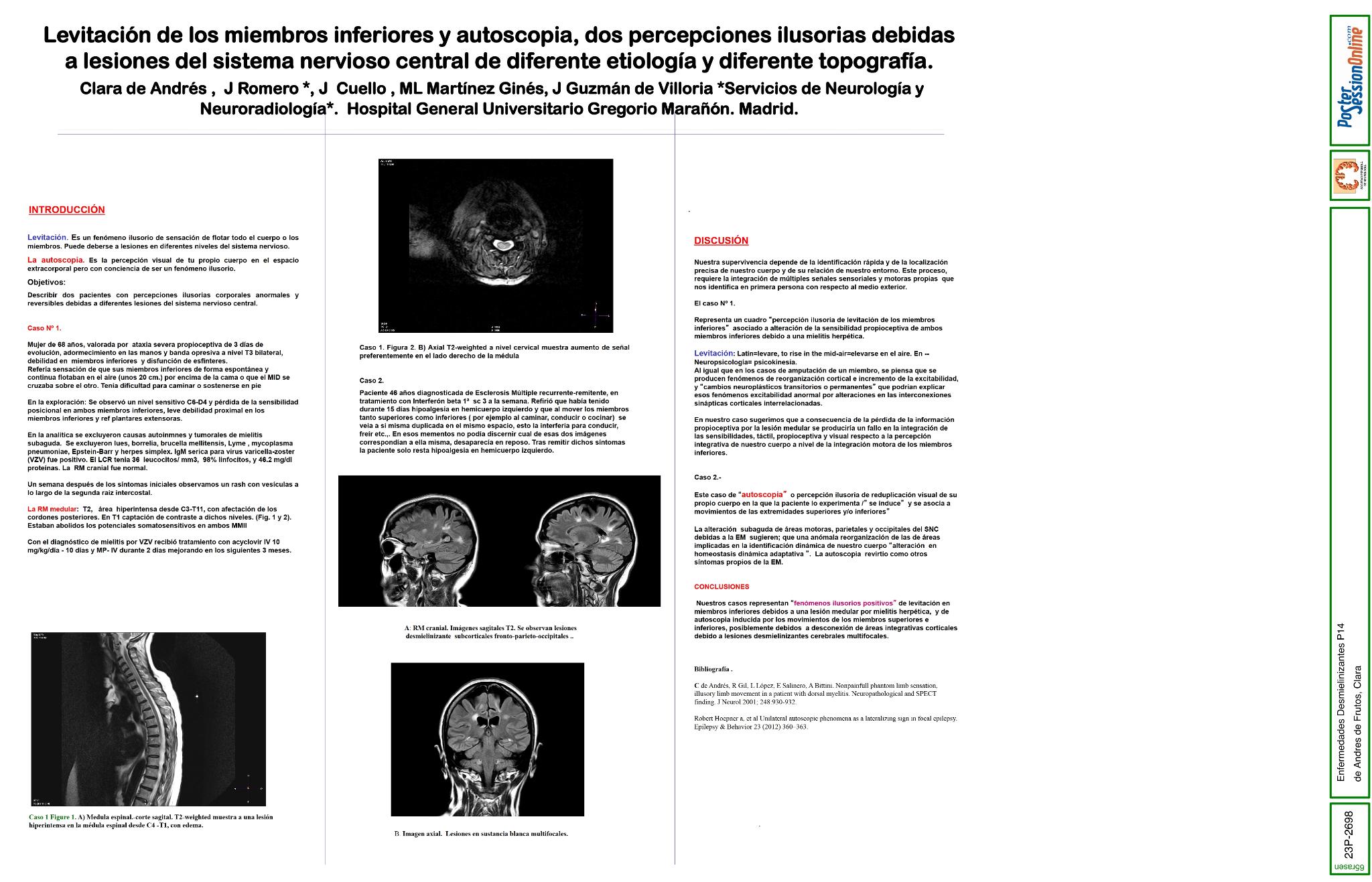 Levitación de los miembros inferiores y autoscopia, dos percepciones ilusorias debidas a lesiones del sistema nerviosos central de diferente etiología y diferente topografía.