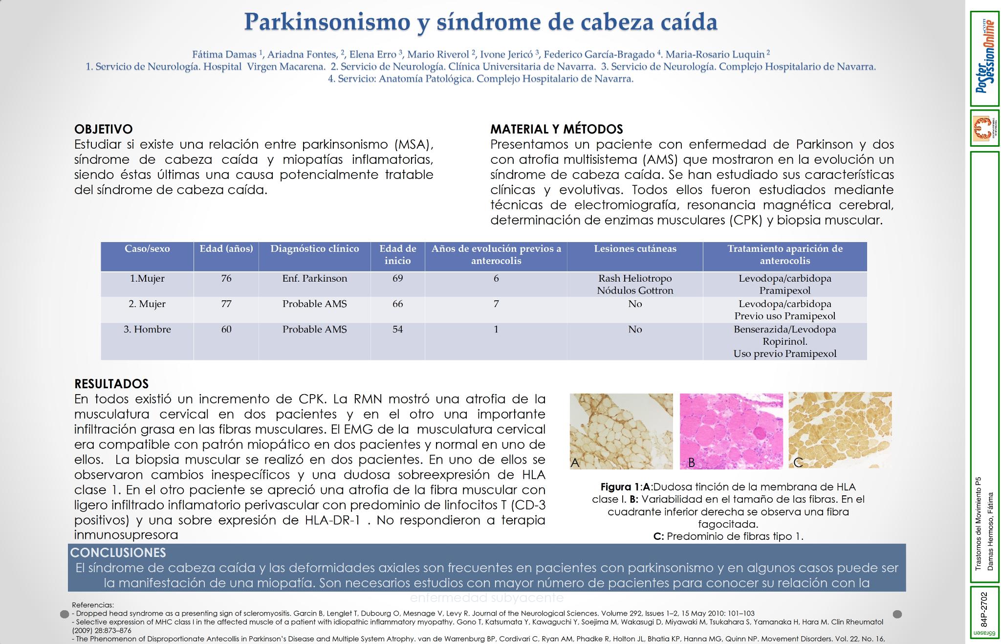 Parkinsonismo y síndrome de cabeza caída