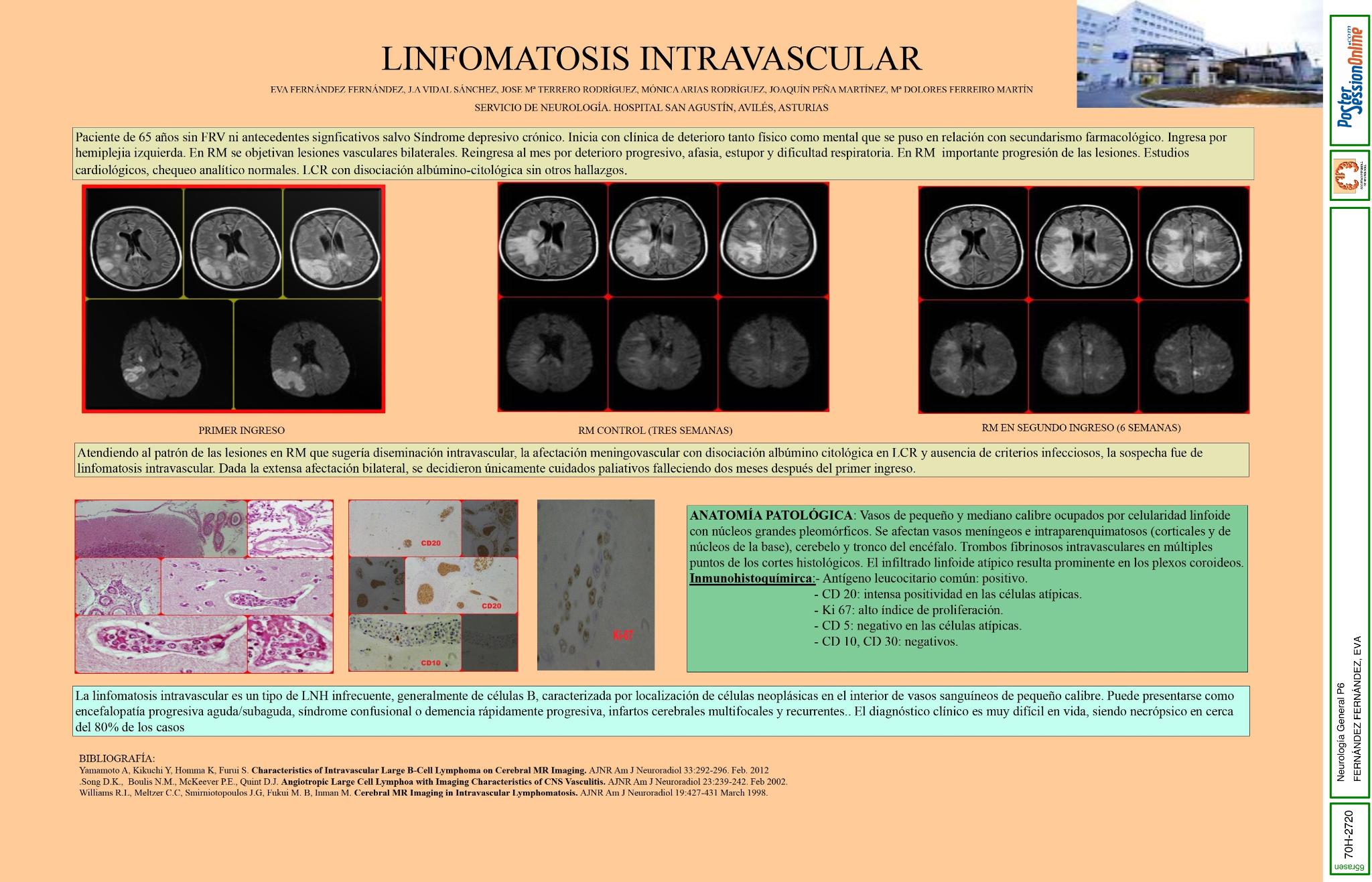 Linfomatosis intravascular encefálica