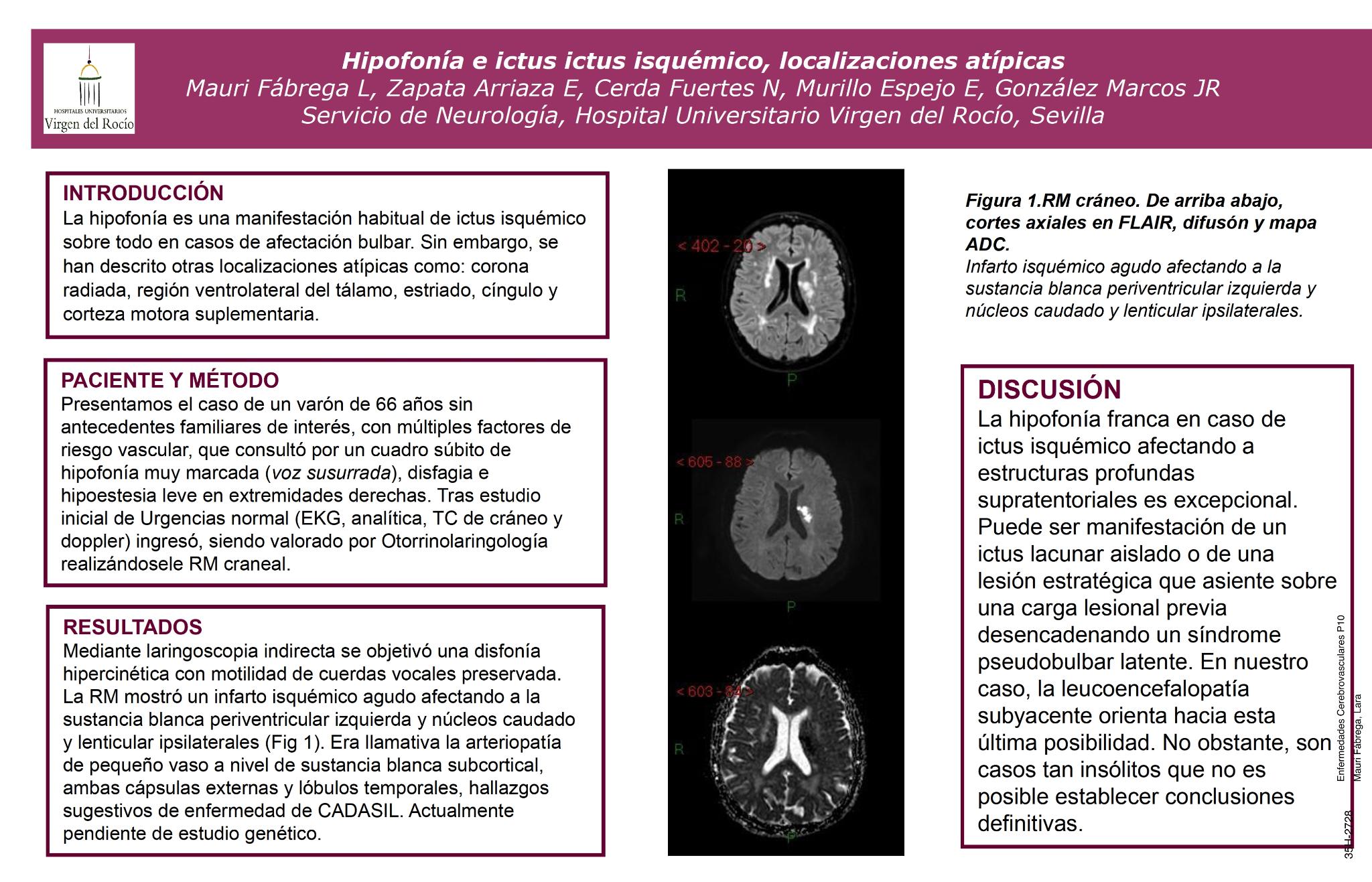 Hiporfonía y disfagia e ictus ictus isquémico, localizaciones atípicas