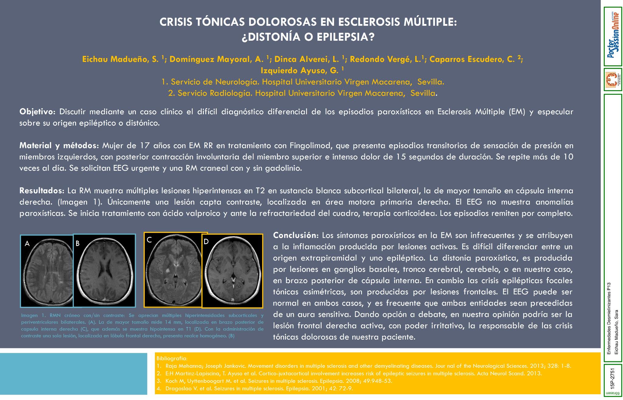 Crisis tónicas dolorosas en Esclerosis Múltiple: ¿Distonía o epilepsia?