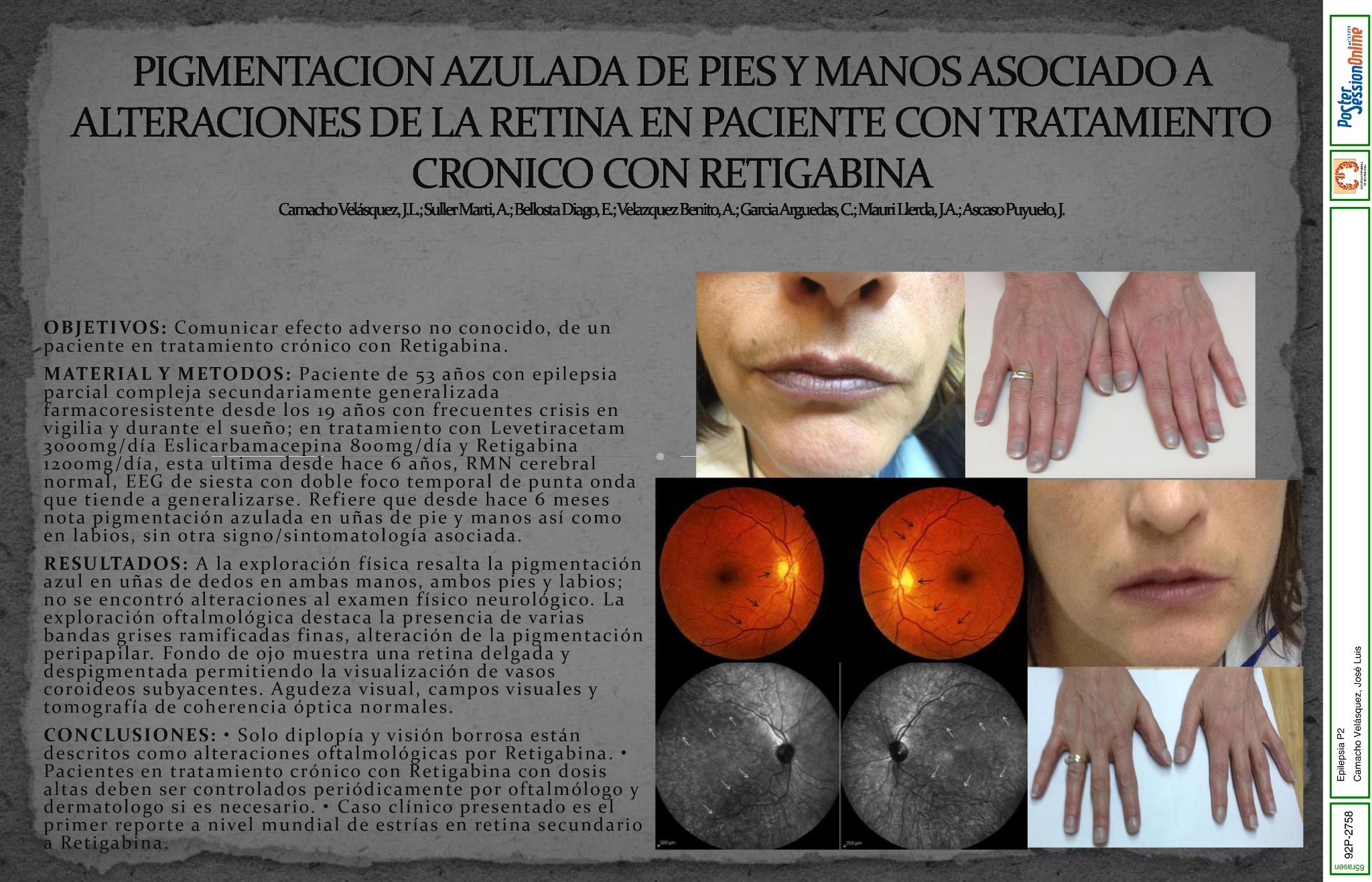 Pigmentación azulada de pies y manos asociado alteraciones de la retina en paciente con tratamiento crónico con Retigabina.