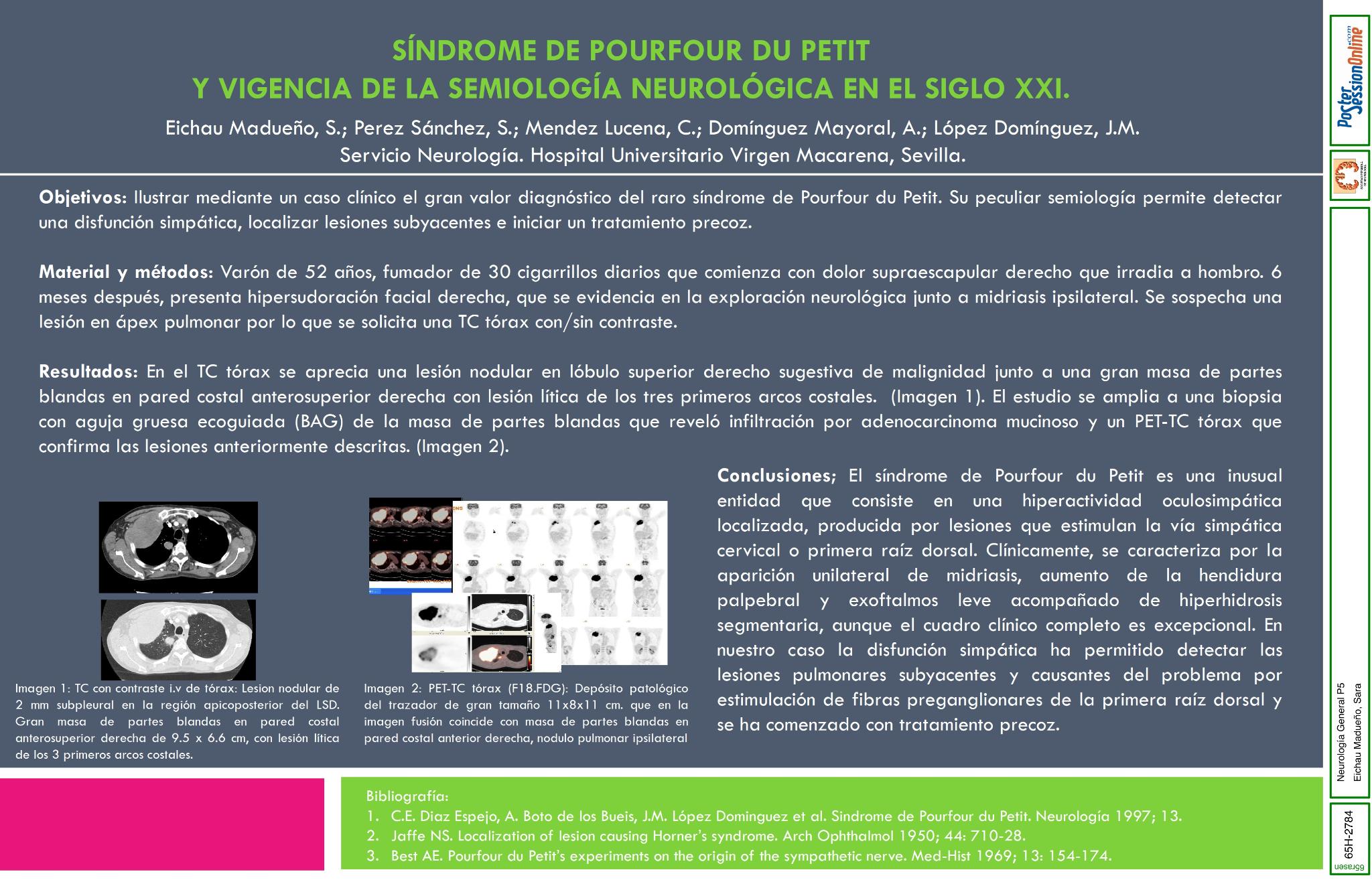 Síndrome de Pourfour du Petit y vigencia de la semiología neurológica en el siglo XXI