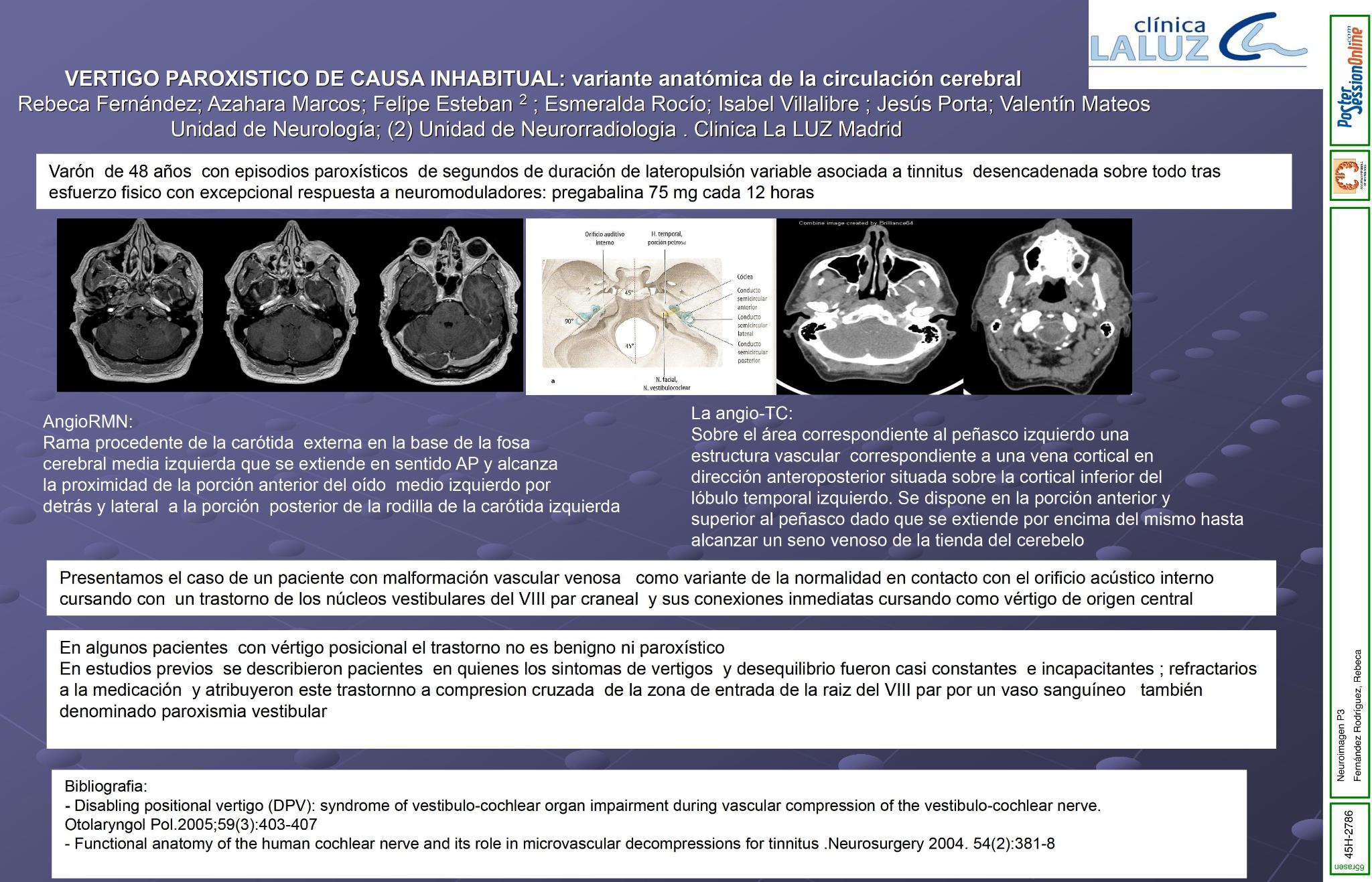 Vértigo paroxístico de causa inhabitual por una  variante anatómica de la circulación cerebral