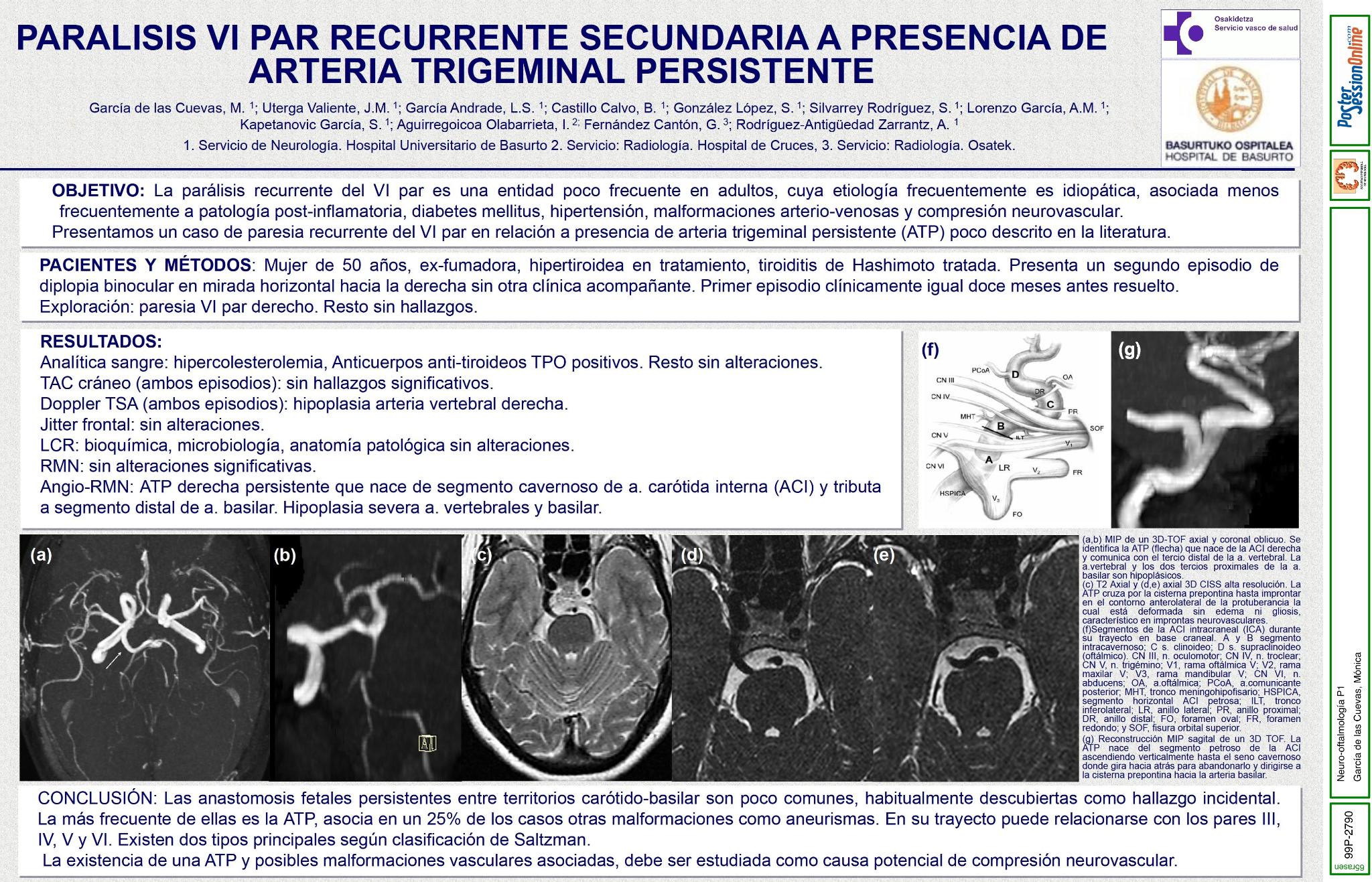 Paralisis del VI par recurrente secundaria a presencia de arteria trigeminal persistente