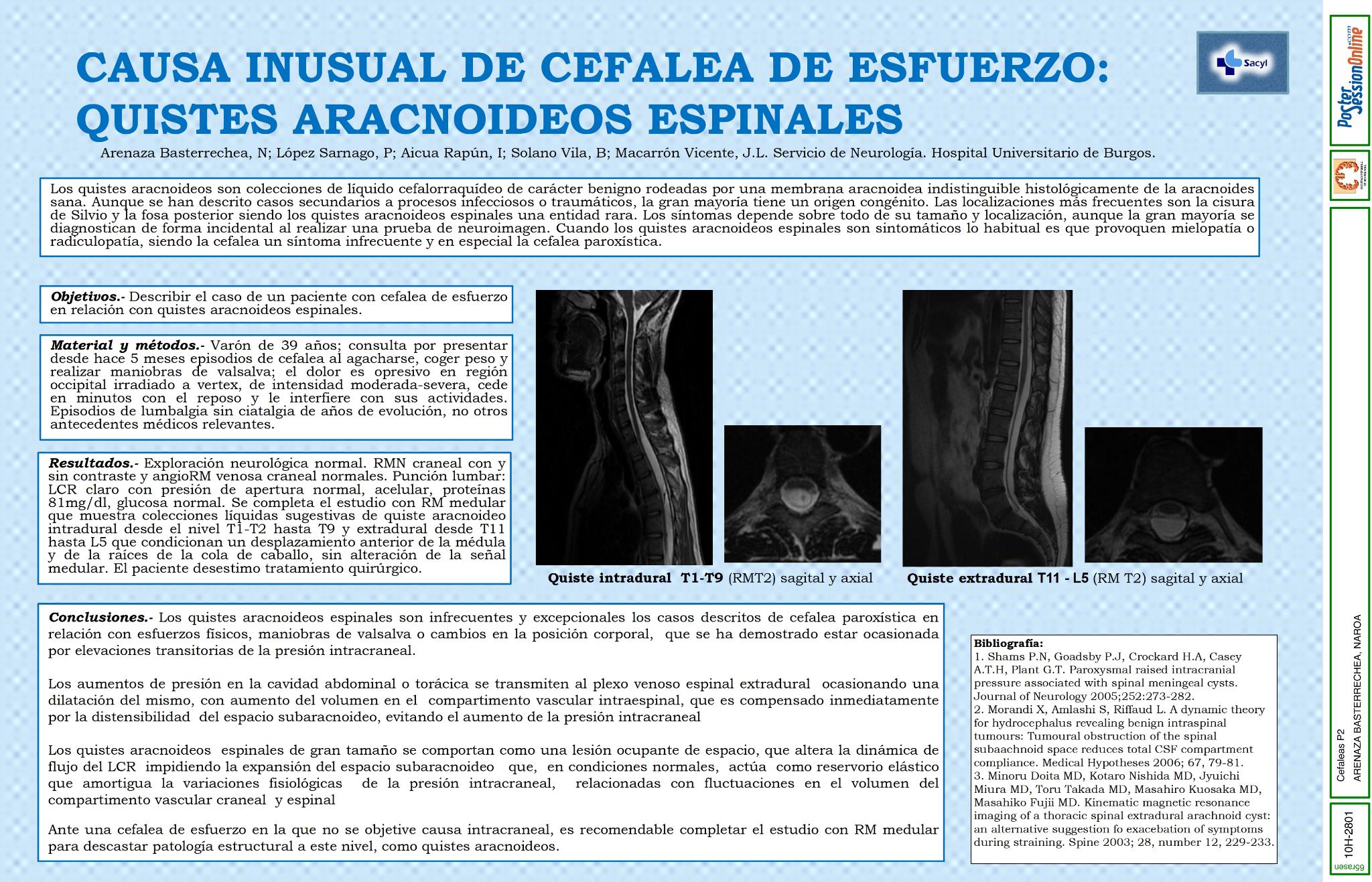 Causa inusual de cefalea de esfuerzo: quistes aracnoideos espinales