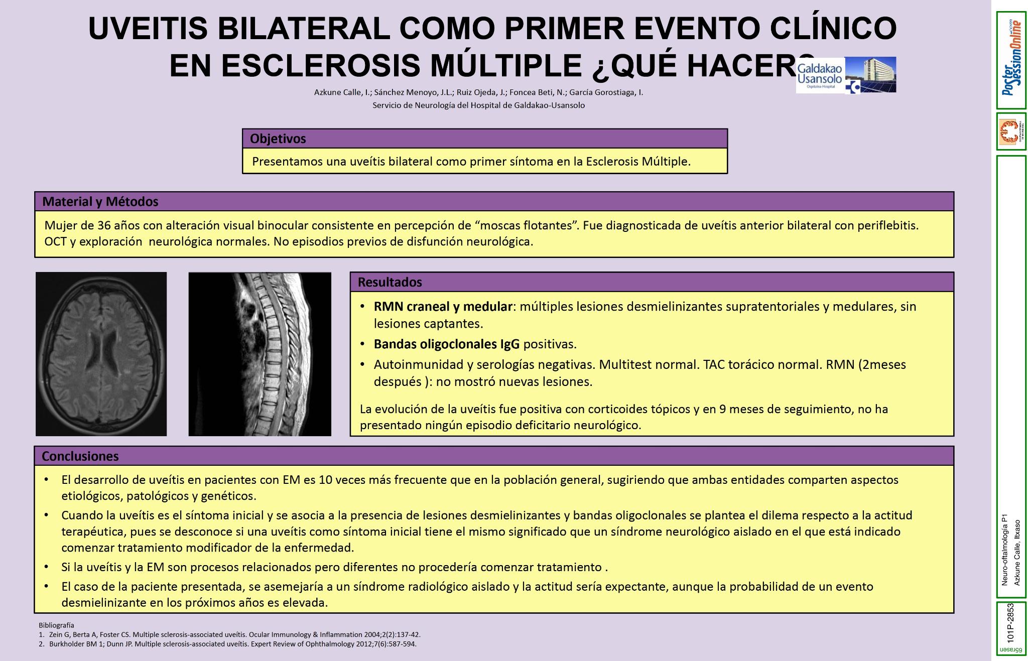 Uveitis bilateral como primer evento clínico en Esclerosis Múltiple. ¿Qué hacer?