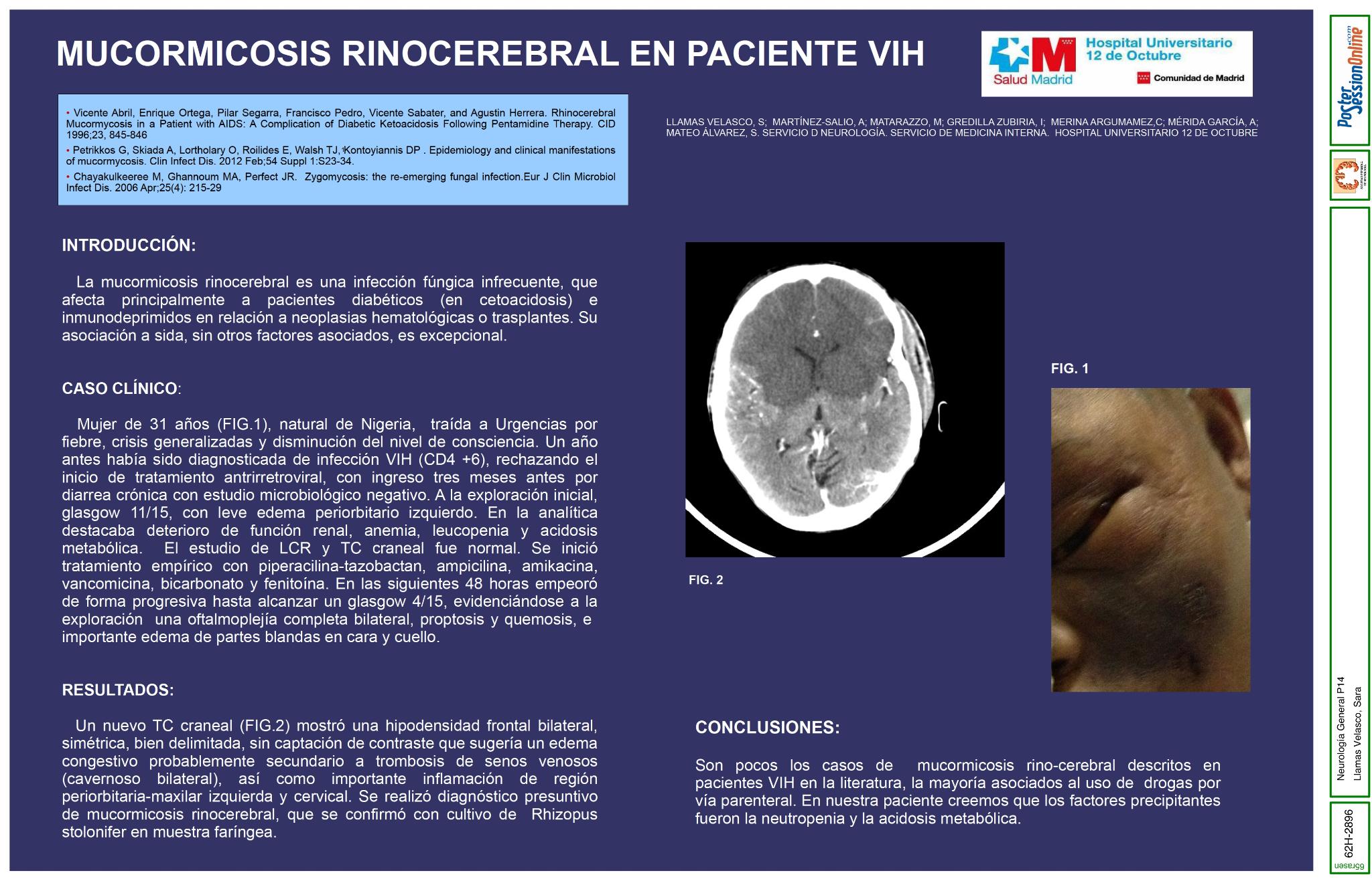 Mucormicosis rinocerebral en paciente VIH