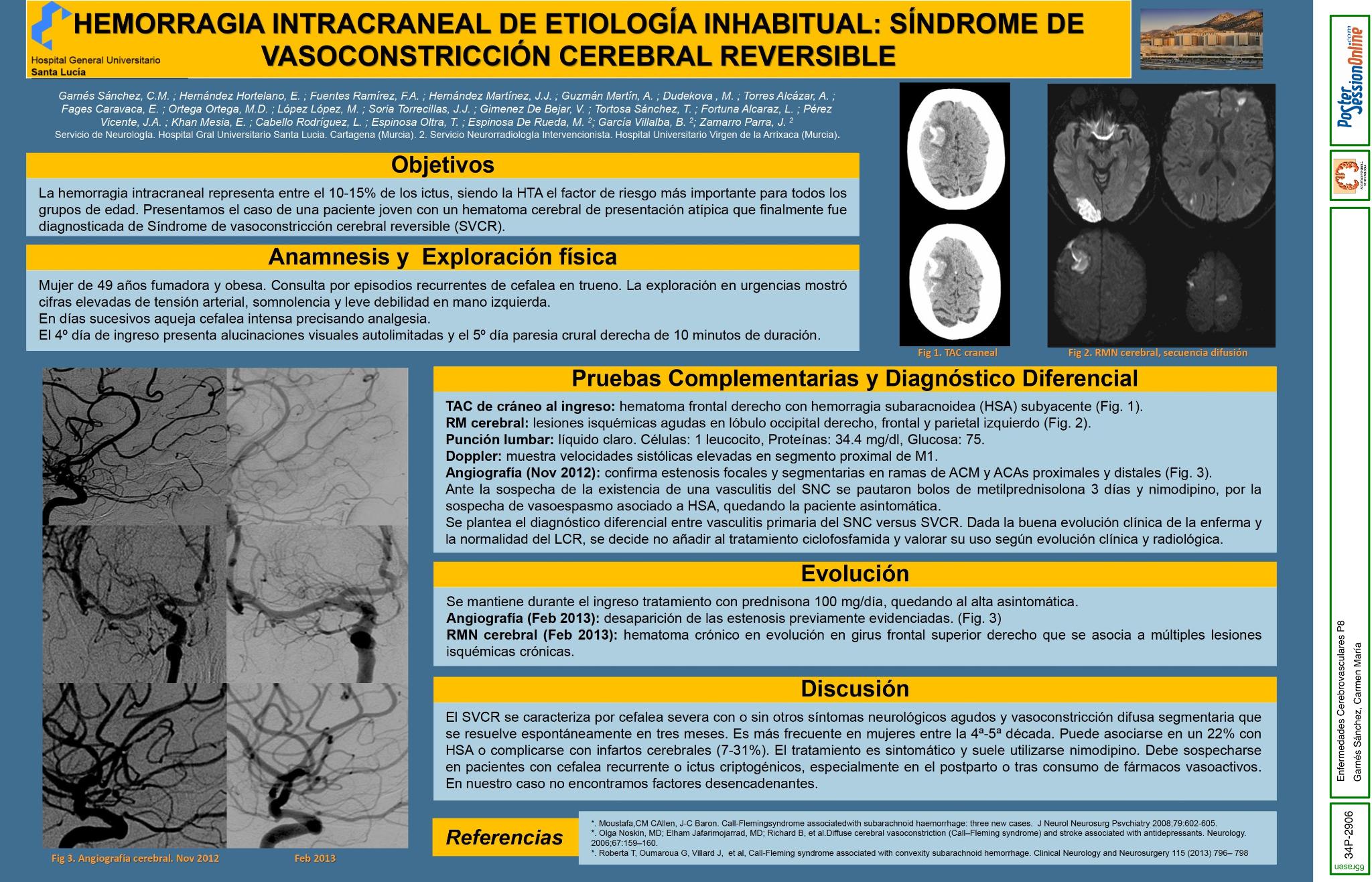 Hemorragia intracraneal de etiología inhabitual: Síndrome de Vasoconstricción Cerebral Reversible (SVCR)