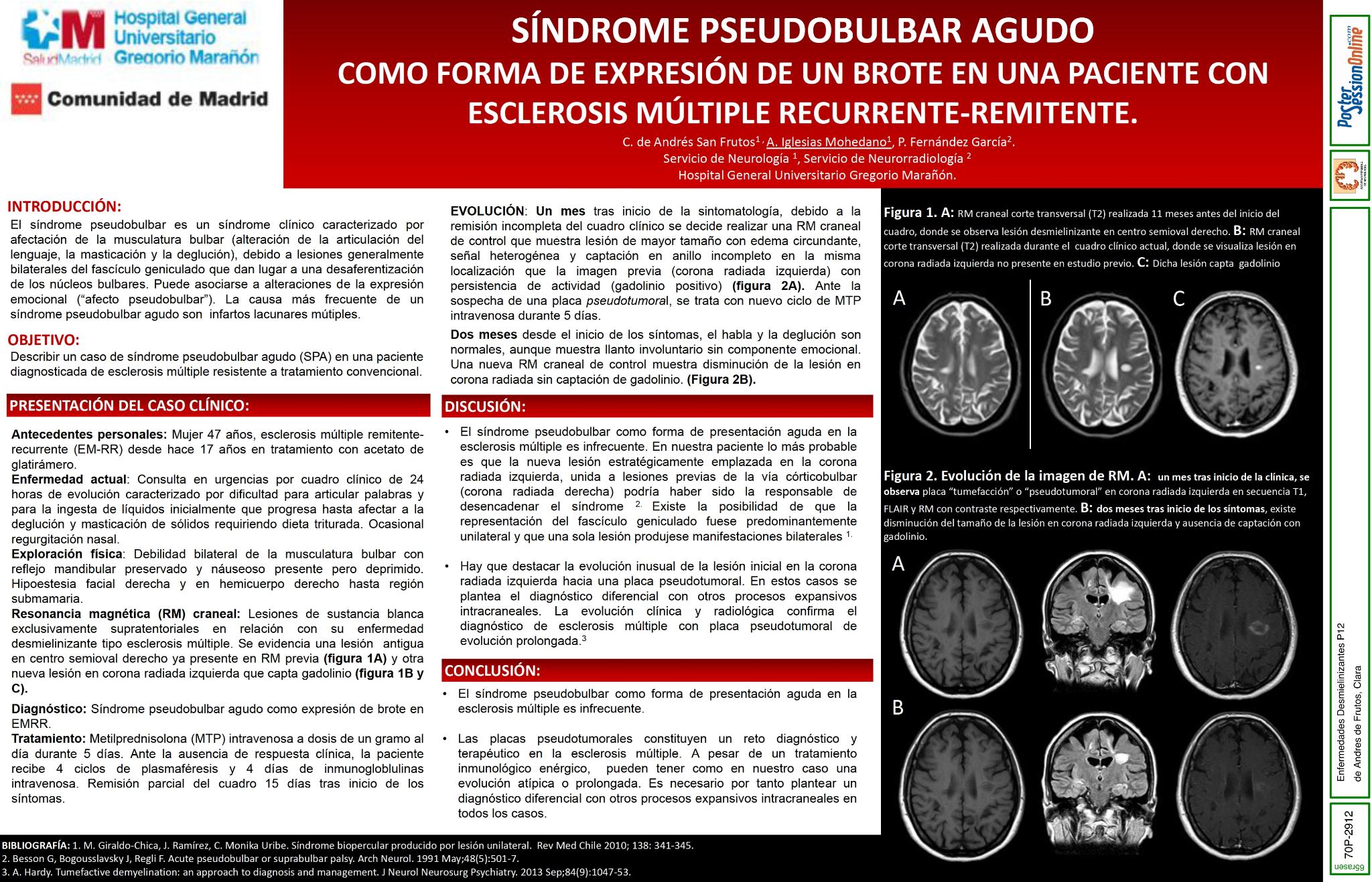 Síndrome pseudobulabar agudo como forma de expressión de un brote en una paciente con esclerosis múltiple recurrente-remtente (EM-RR).
