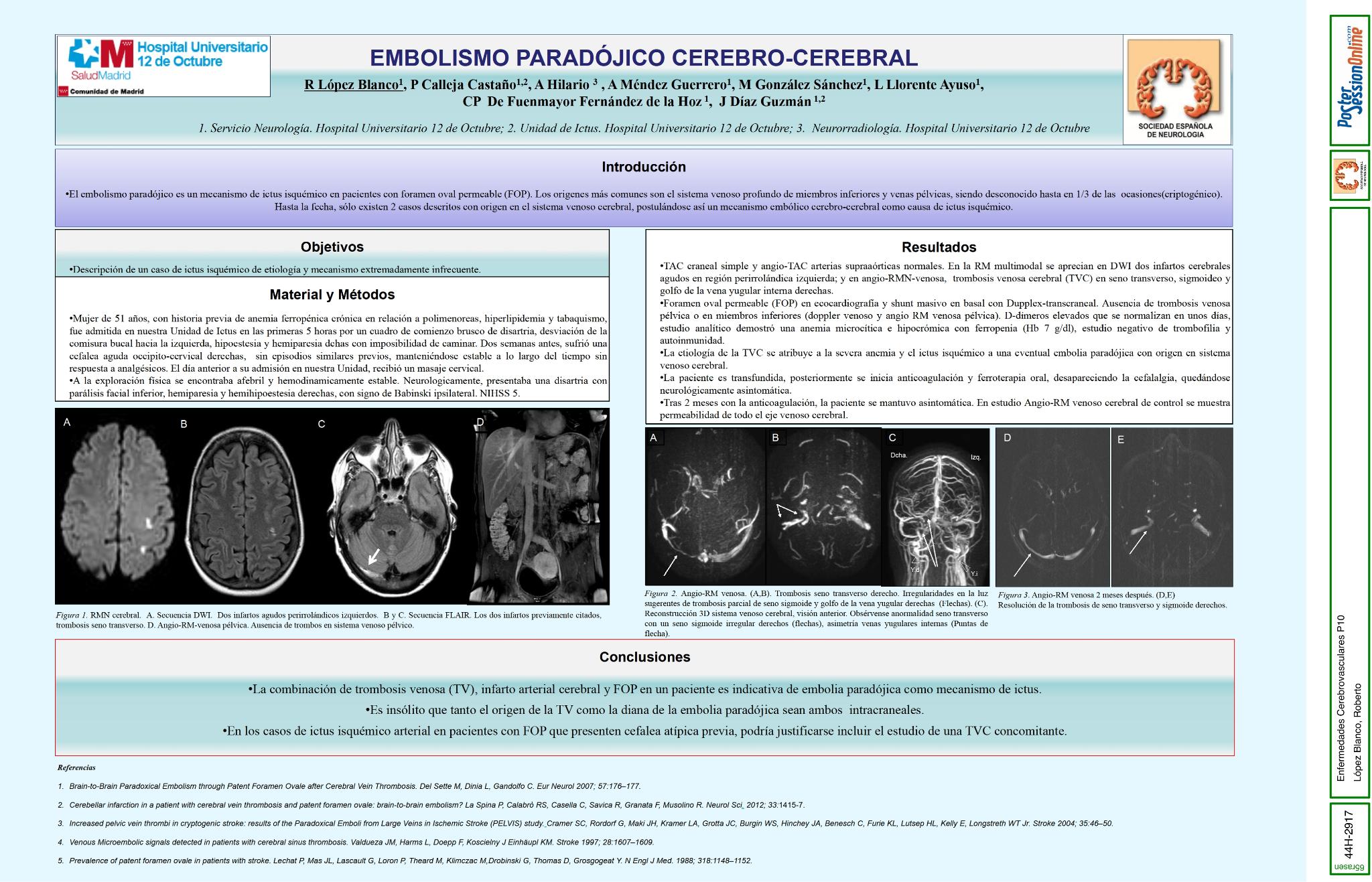 Embolismo paradójico cerebro-cerebral