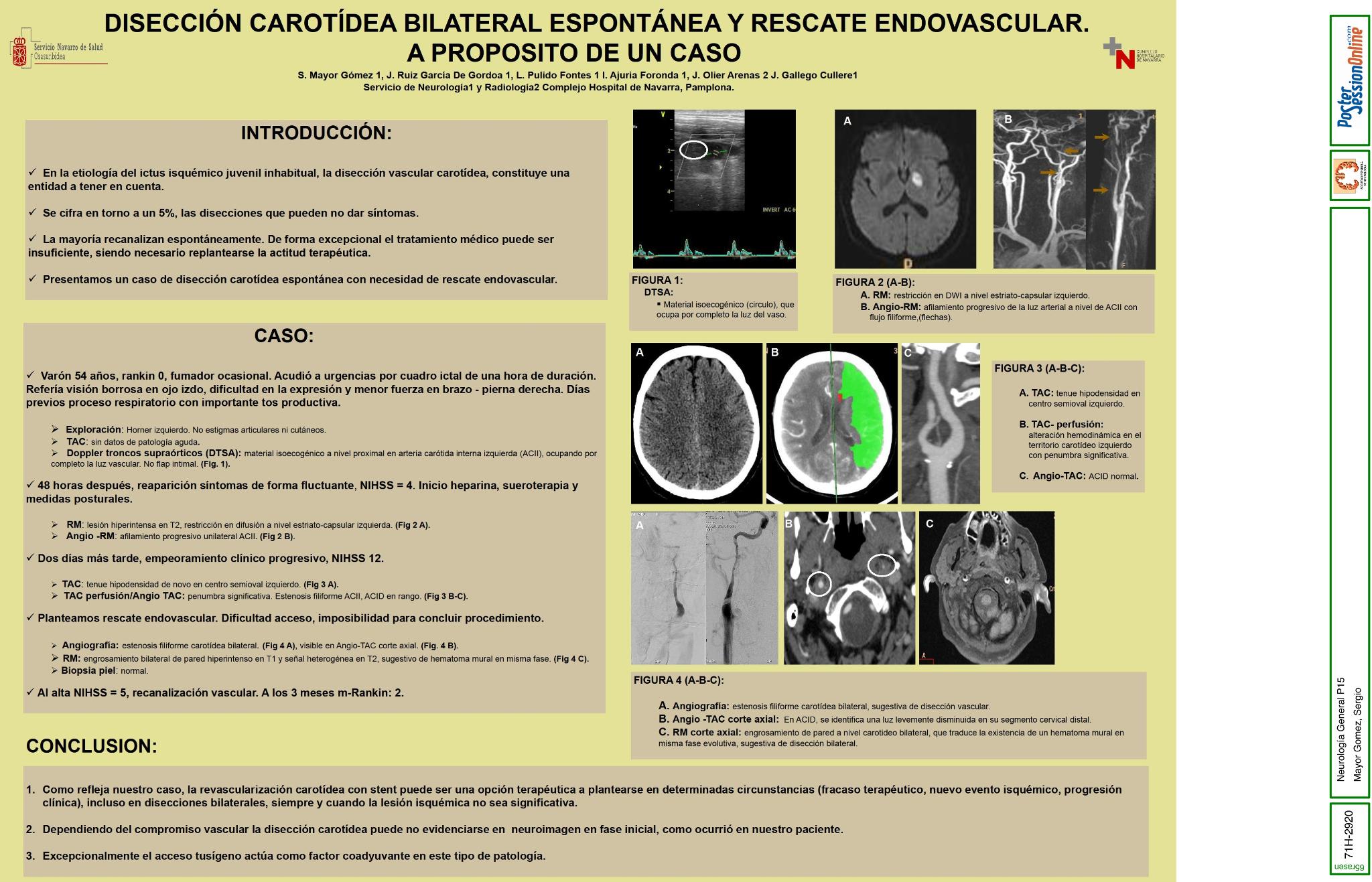 Disección carotídea bilateral espontánea y rescate endovascular. A proposito de un caso