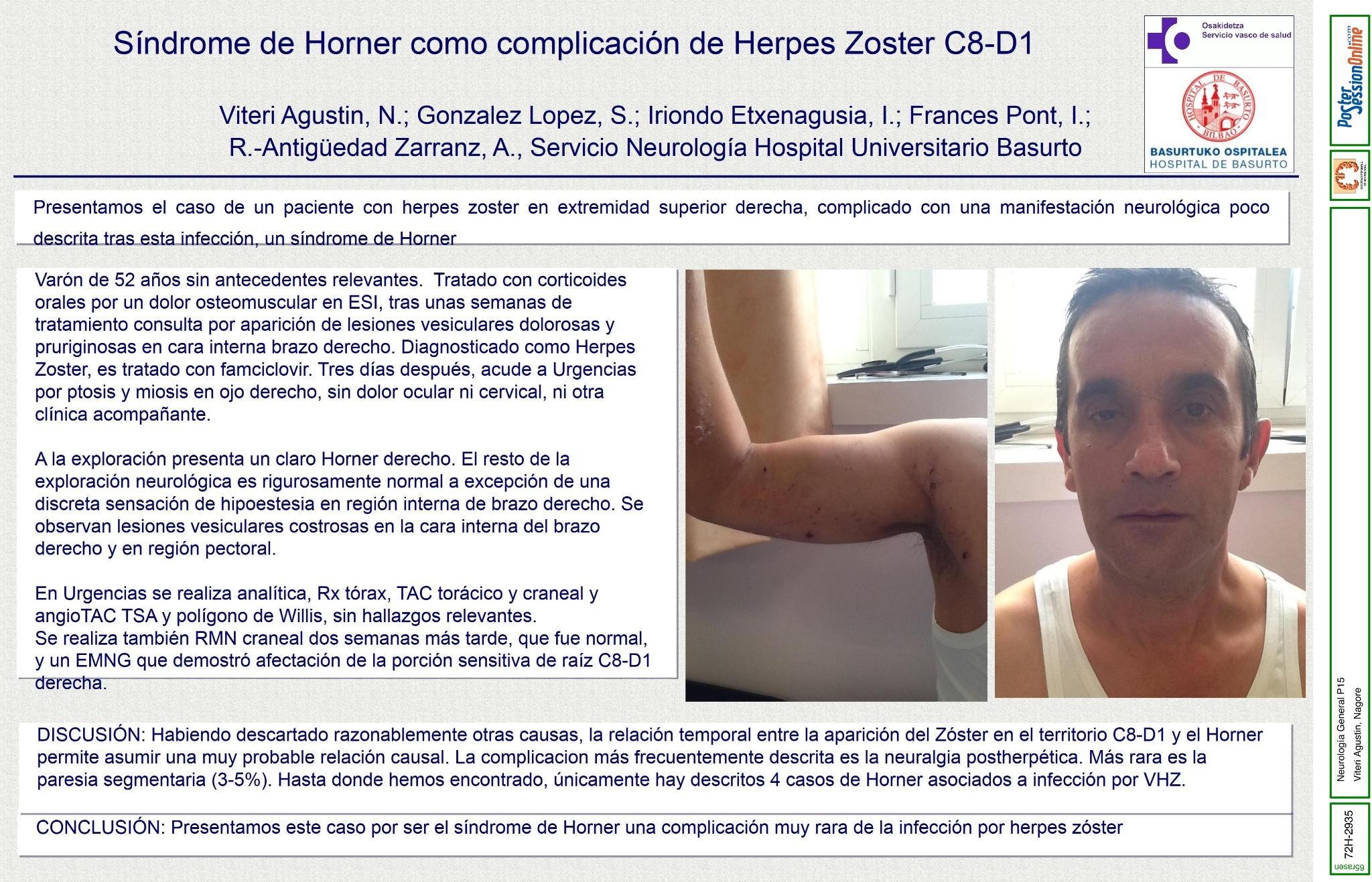 Síndrome de Horner como complicación de Herpes Zoster C8-D1