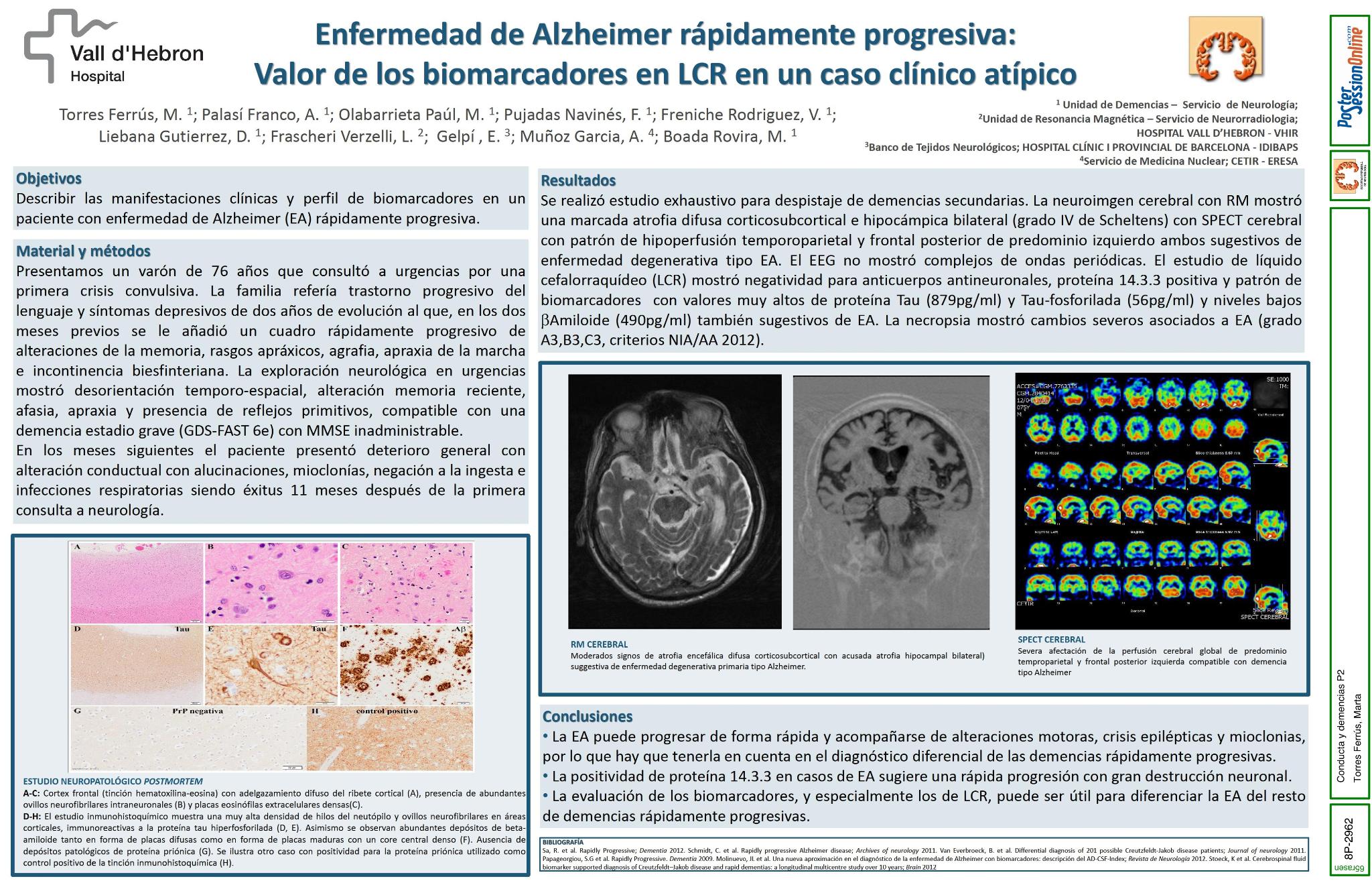 Enfermedad de Alzheimer rápidamente progresiva: valor de los  biomarcadores en LCR en un caso clínico atípico