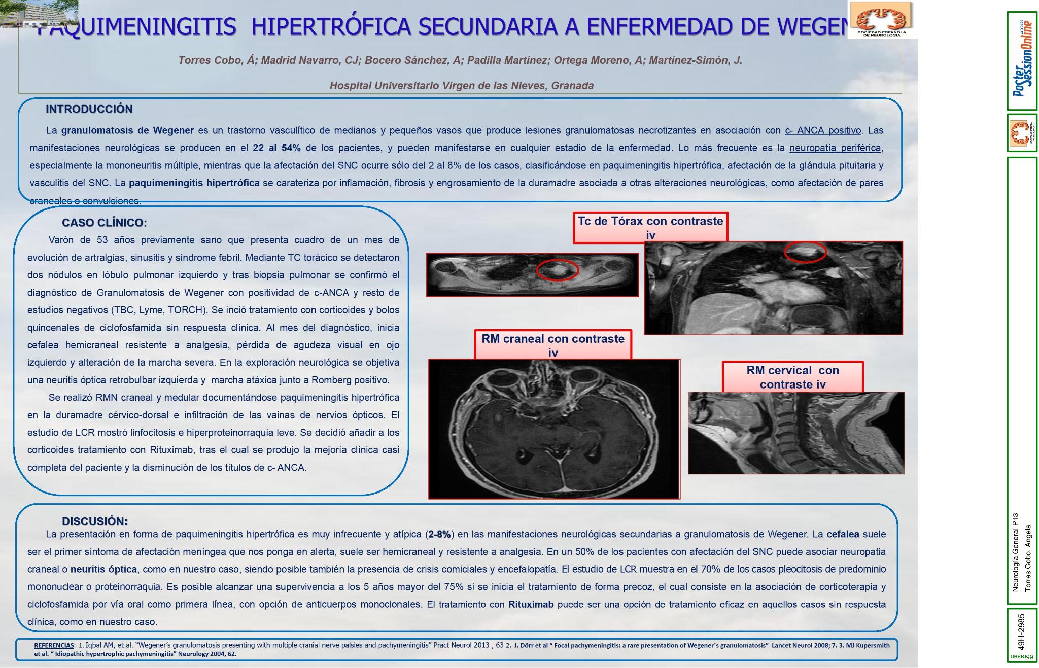 Paquimeningitis hipertrófica secundaria a Enfermedad de Wegener