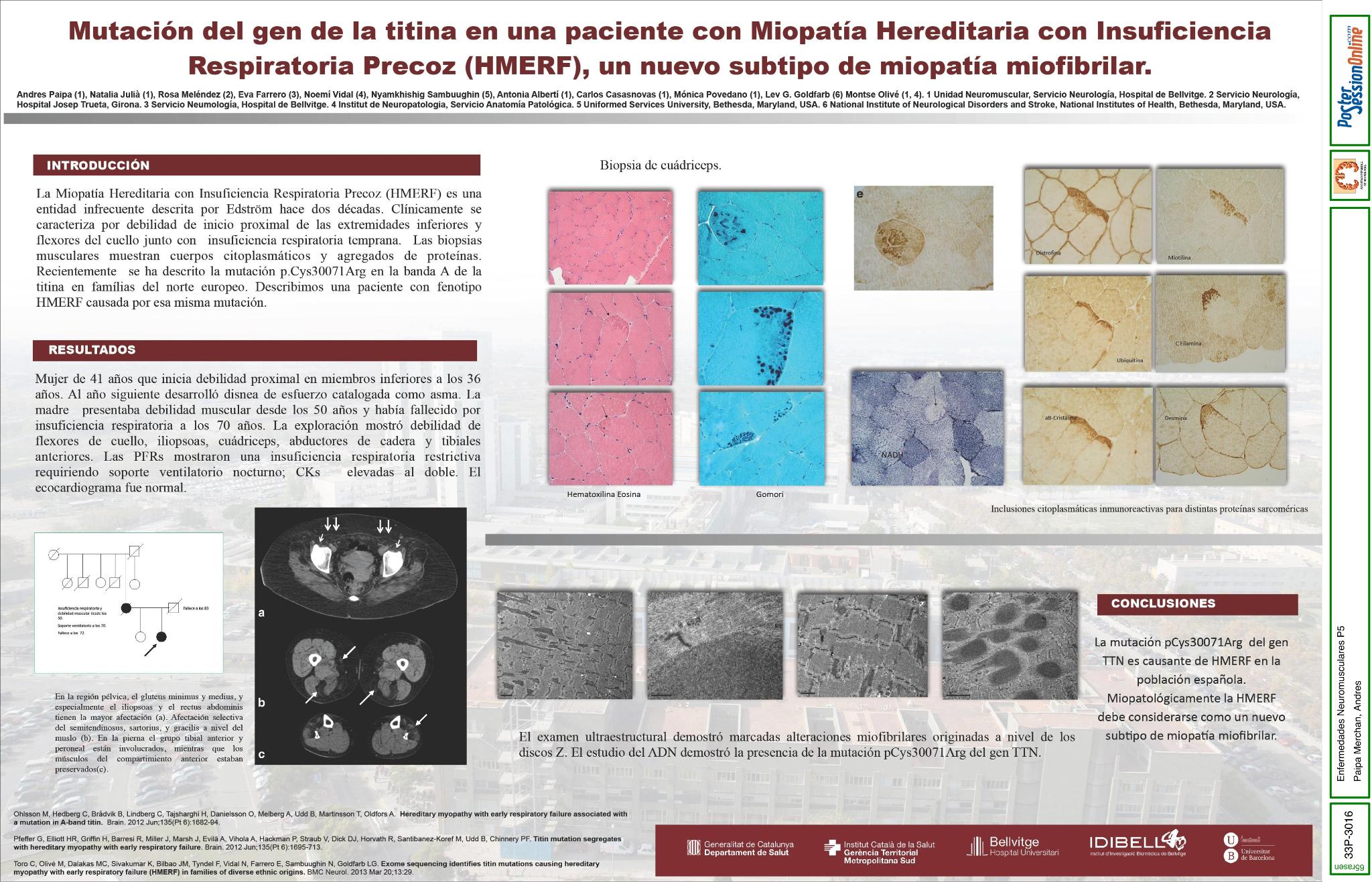 Mutación del gen de la titina en una paciente con Miopatía Hereditaria con Insuficiencia Respiratoria Precoz (HMERF), un nuevo subtipo de miopatía miofibrilar.
