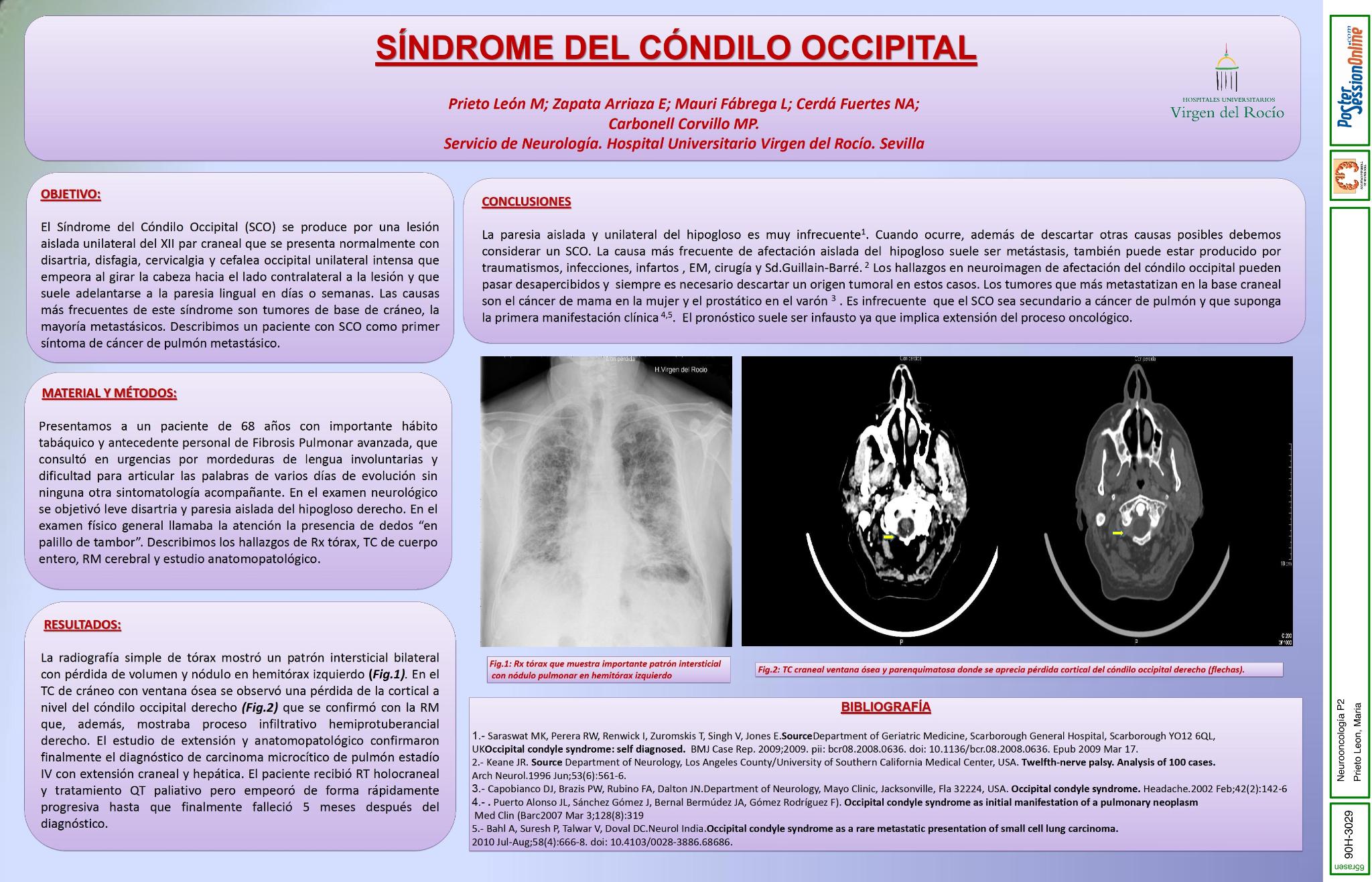 Síndrome del Cóndilo Occipital