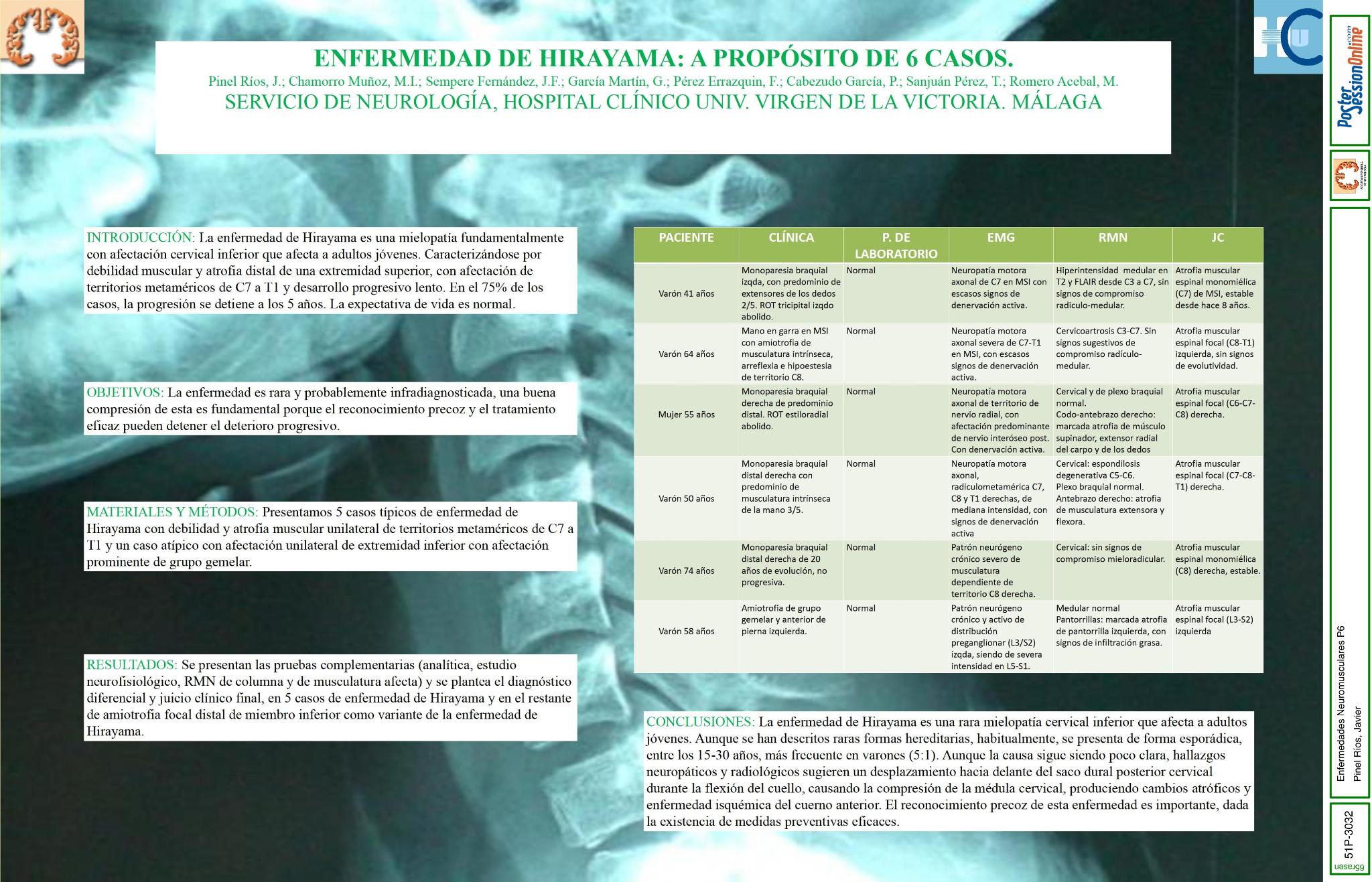 Enfermedad de Hirayama: a propósito de 6 casos.
